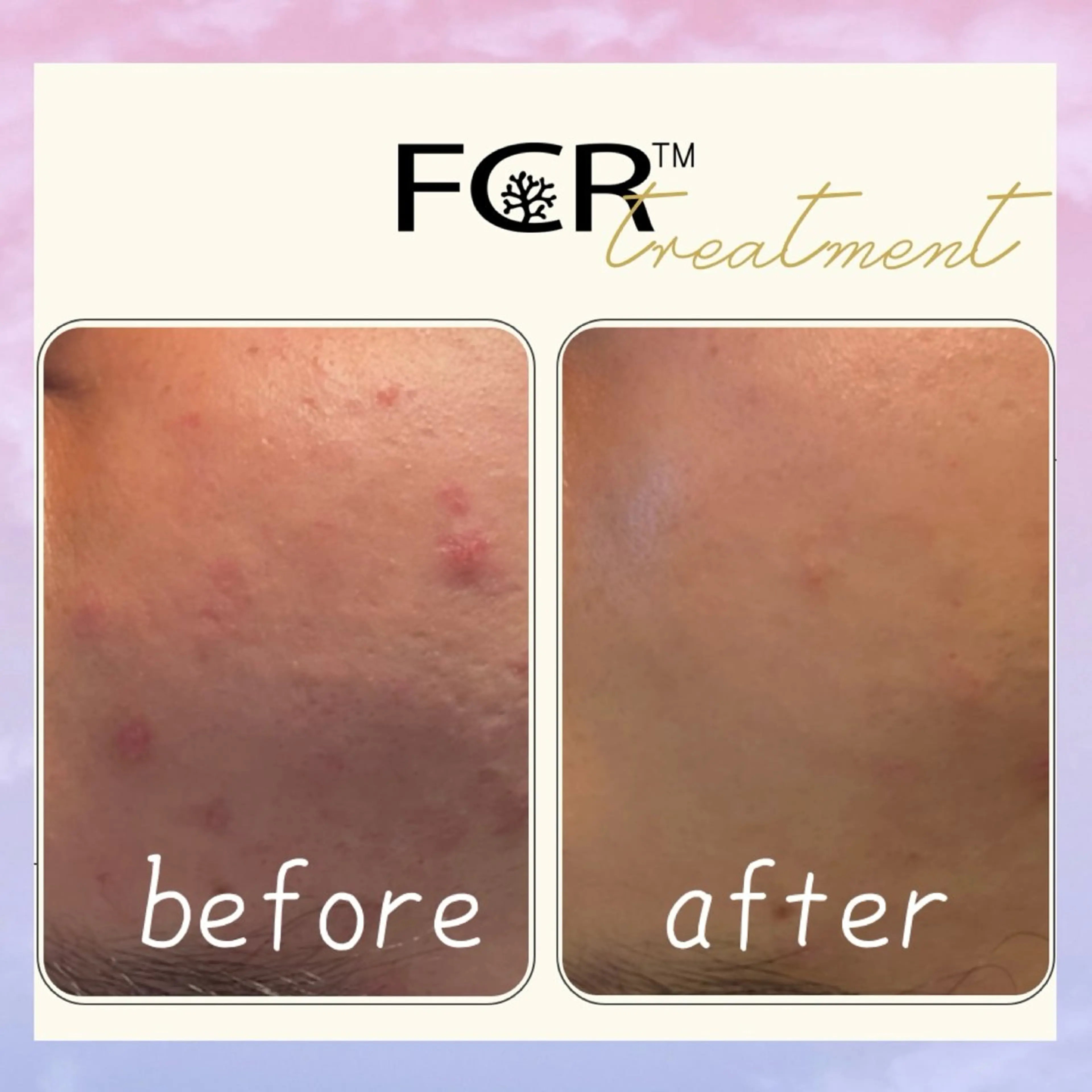 メンズ メンズ韓国風 ニキビ 毛穴ケア シャルム ココ みさのエステ・リラクイメージ