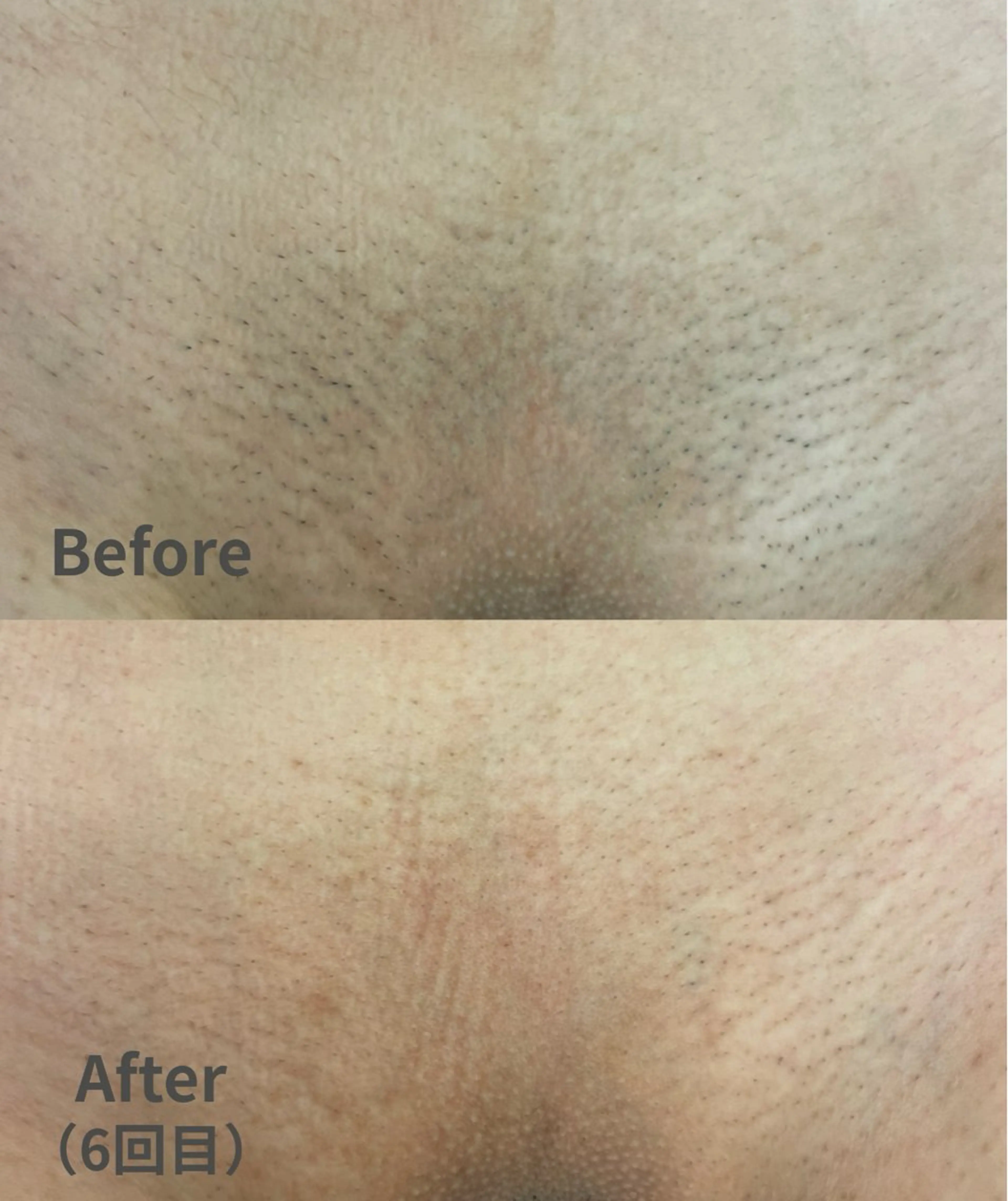 【女性人気No.2】効果重視！VIOつるすべ脱毛（清潔感UP）￥2,980（女性のみ）の写真