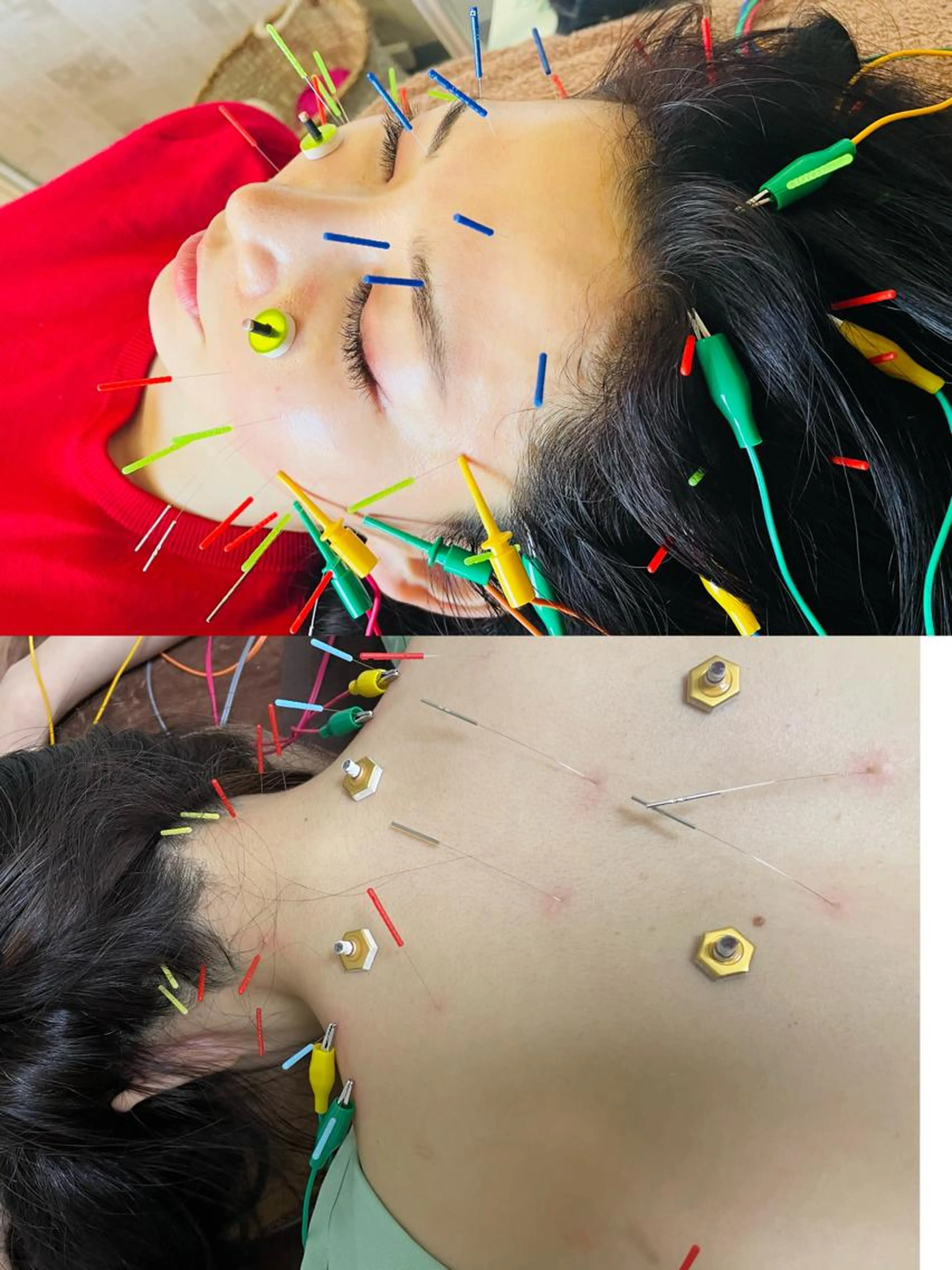 【お身体施術人気NO.2】首肩が限界80分！首肩の鍼マッサージ＋美容鍼で首肩の滞りも取り除き小顔！たるみ改善くすみ除去の写真