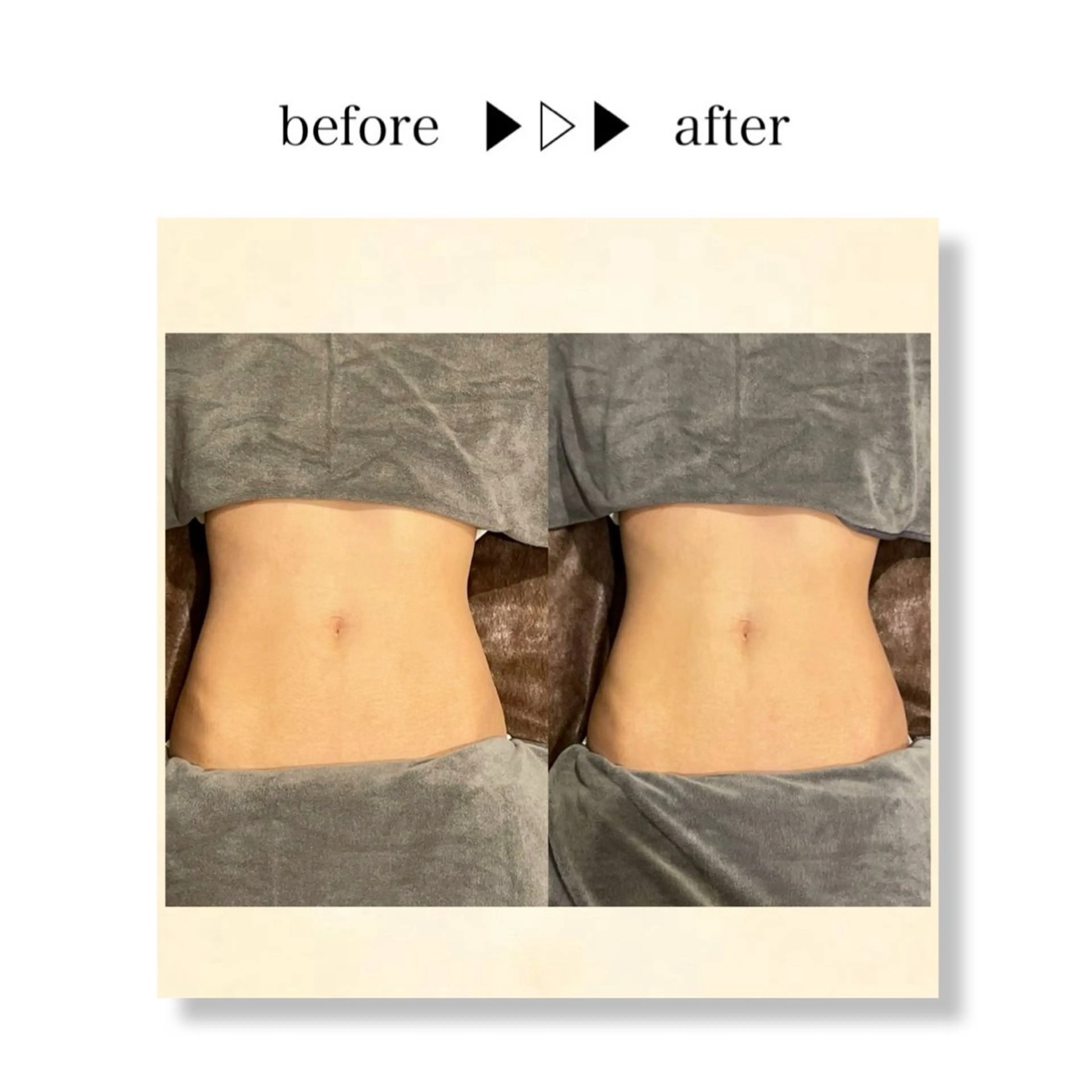 🉐4/13限定🉐【お腹45分8000円】（ハイパーナイフEX)➕ハイパーシェイプでセルライト潰し🙌🏻の写真