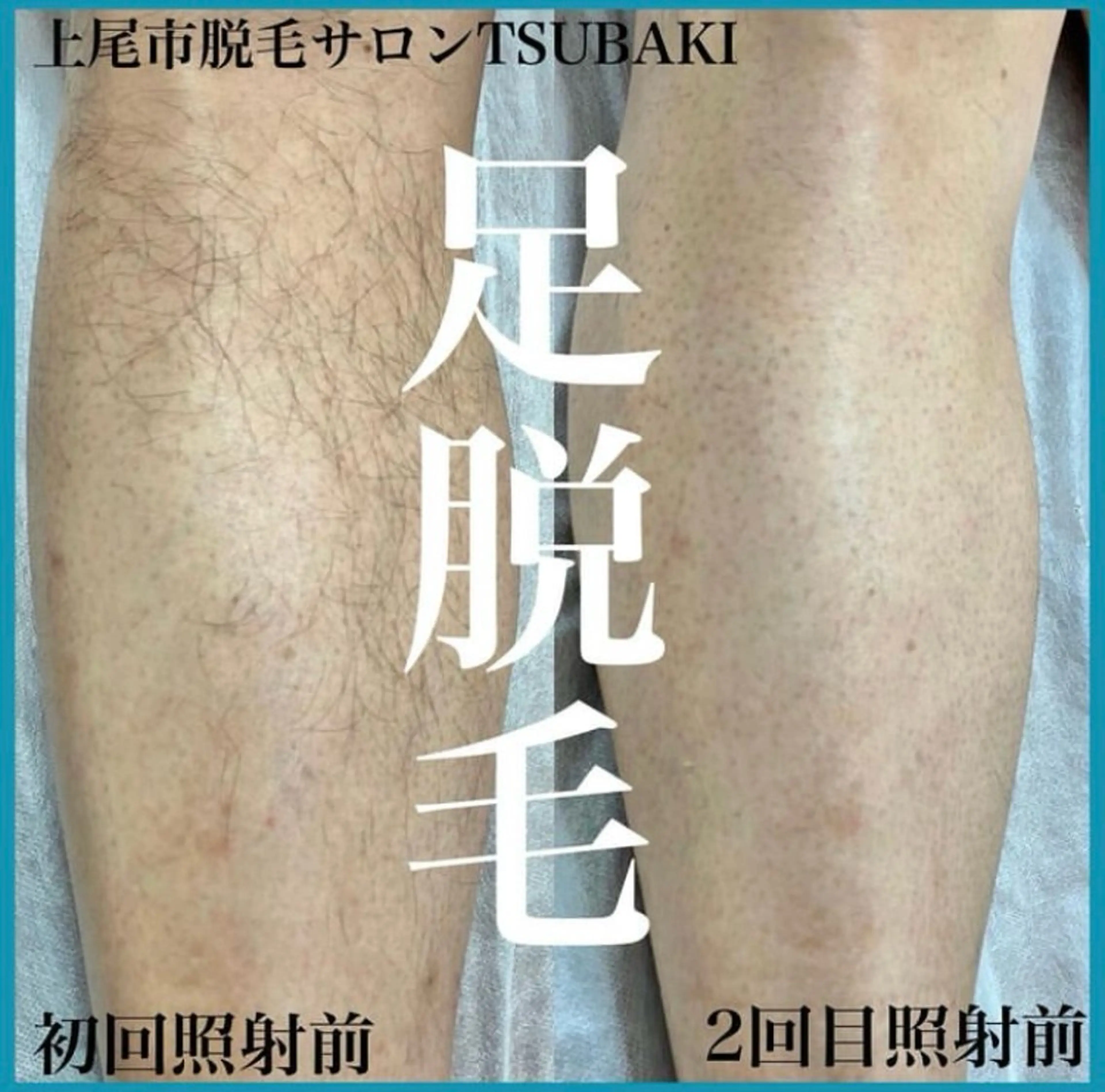 メンズ 脱毛 TSUBAKI上尾店所属・TSUBAKI上尾店 松下のエステ・リラクイメージ