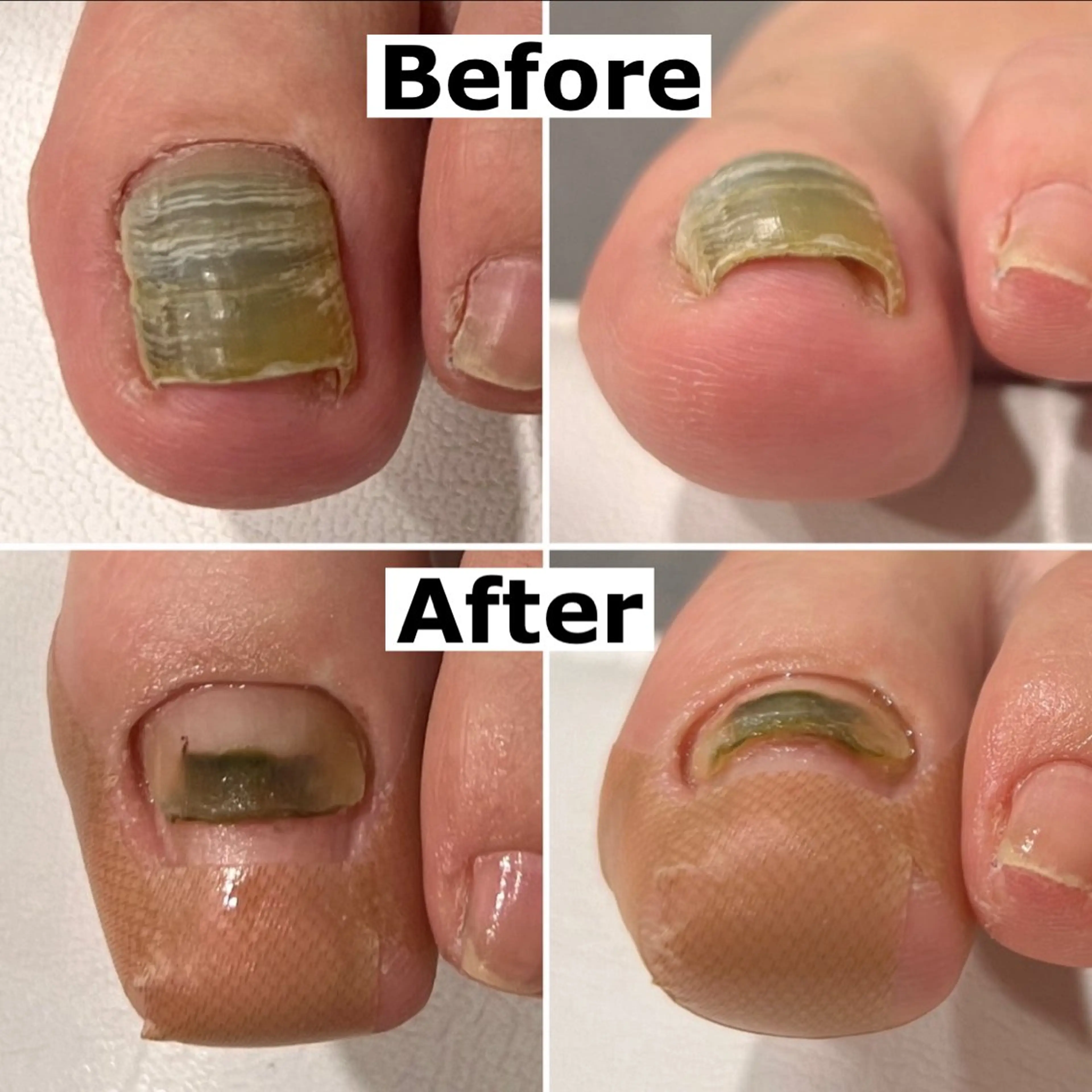 ネイル Mellow nail所属・巻爪無料モデル募集 ✨🦶MEGUMIのネイルデザイン