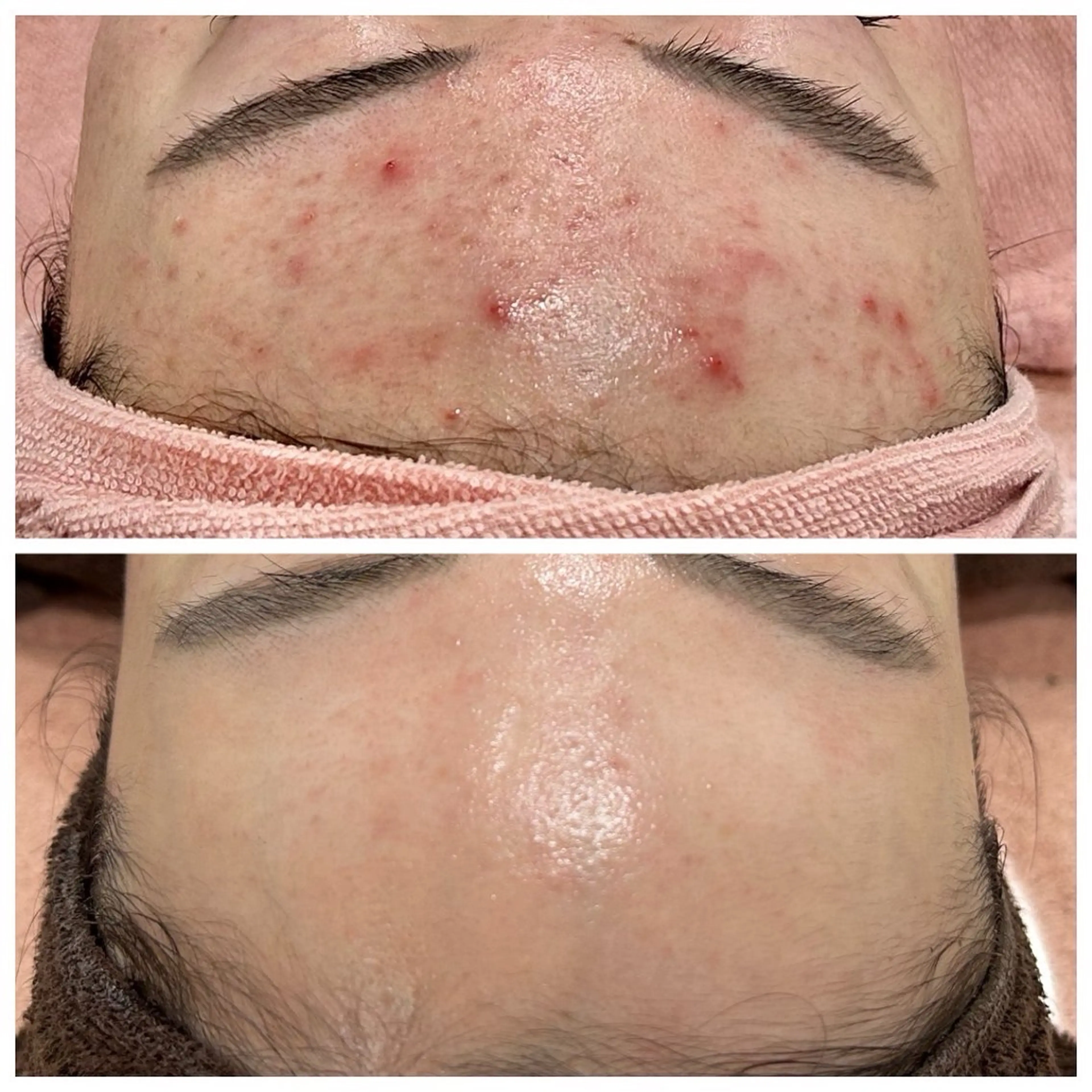 🌿【ハーブピーリングで素肌美人へ】🌿の写真