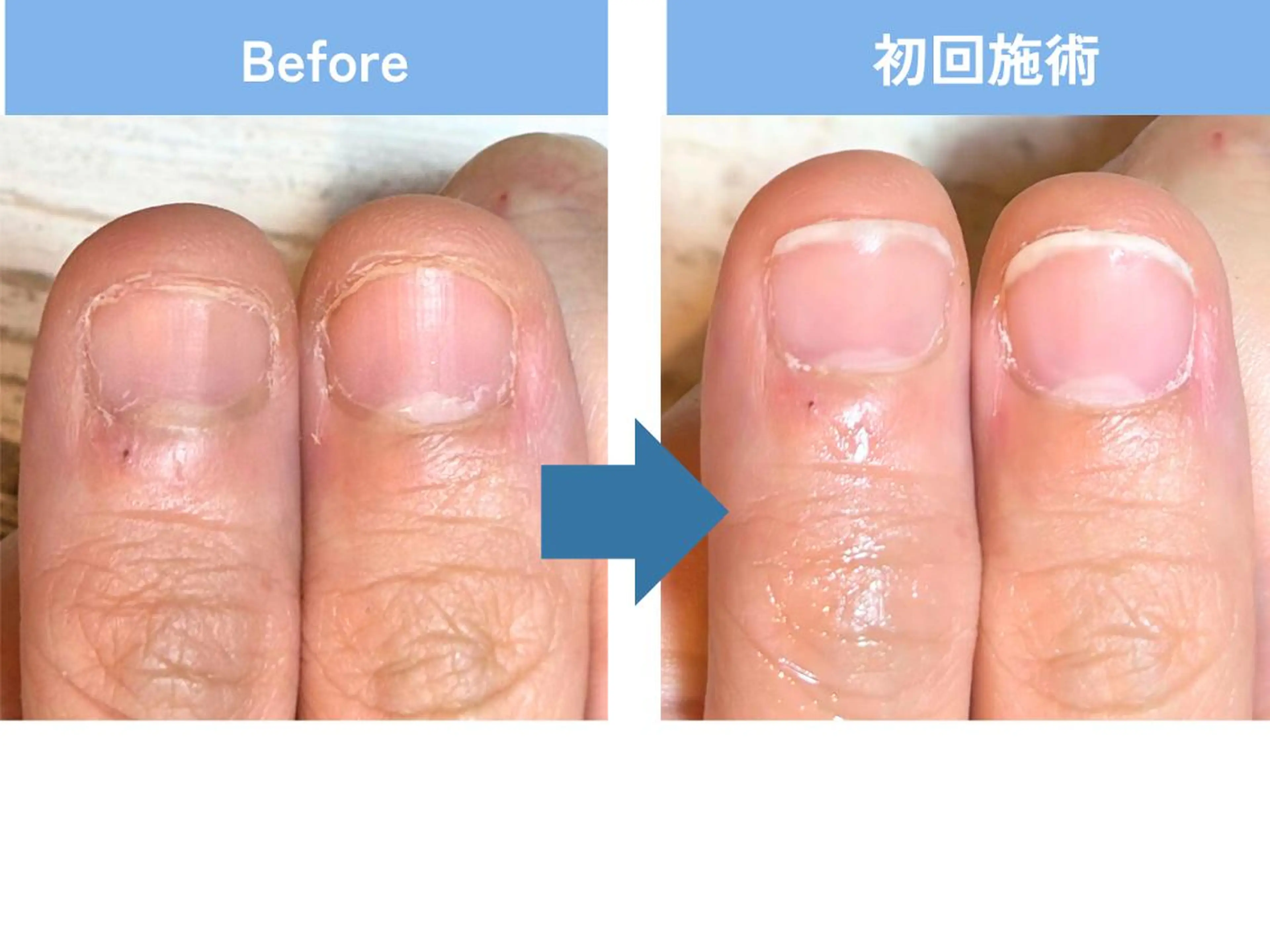 ネイル 深爪矯正・自爪育成 ネイルサロンアモまいのネイルデザイン