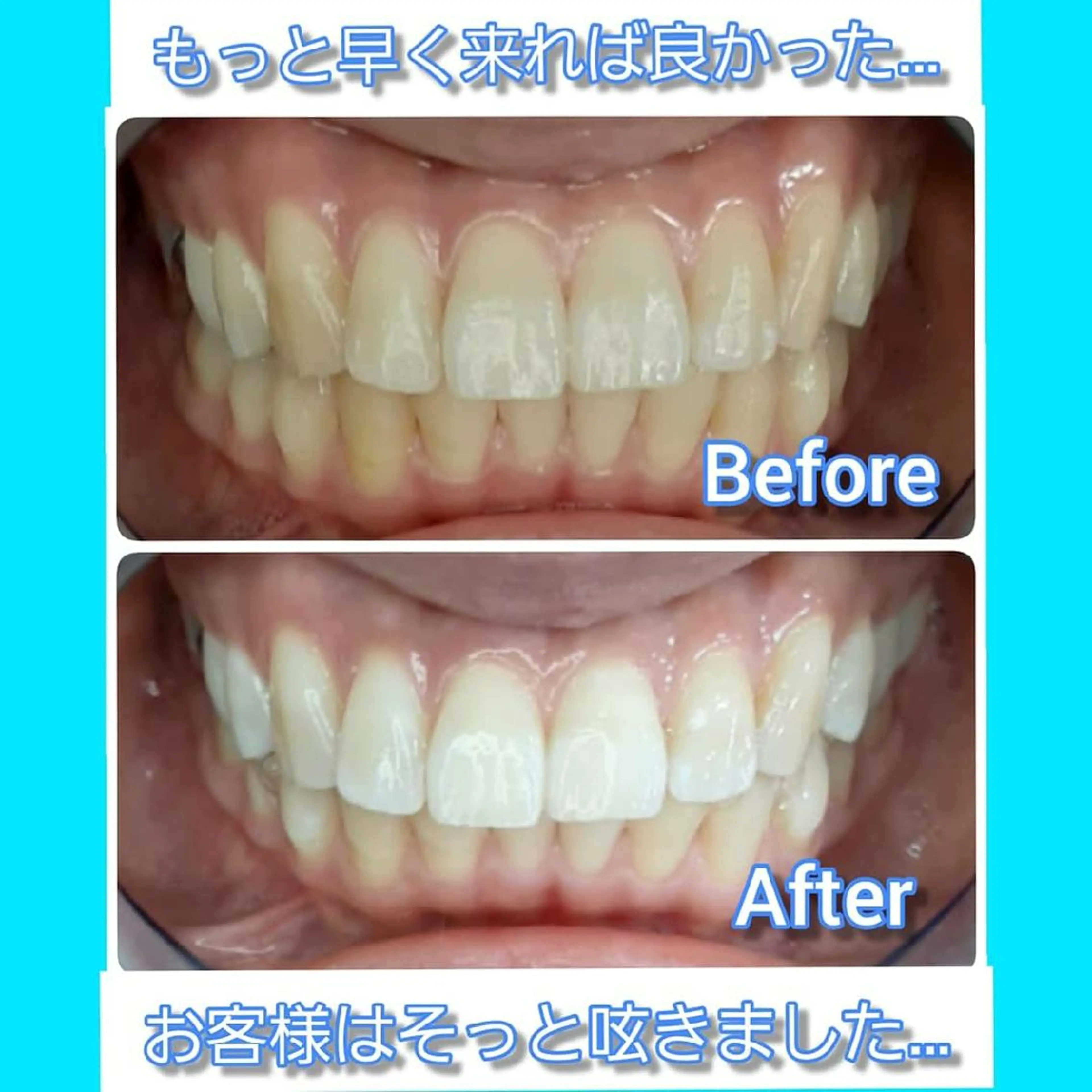 【再来】期間限定!もう一度セルフホワイトニング体験をしたい方😊✨10分照射×2回!の写真