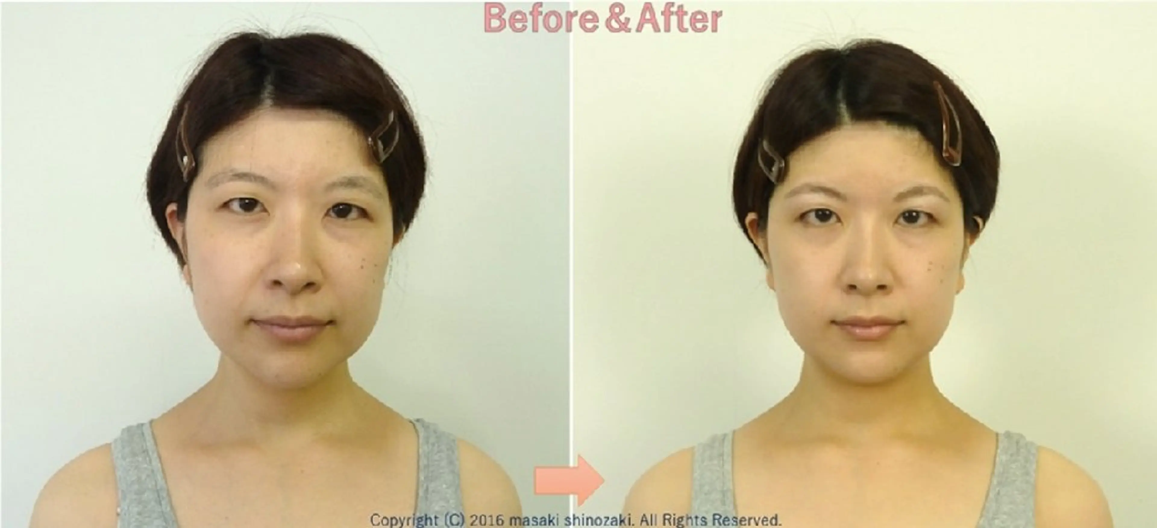 ブライダル美容整体(スッキリ体&小顔)の写真