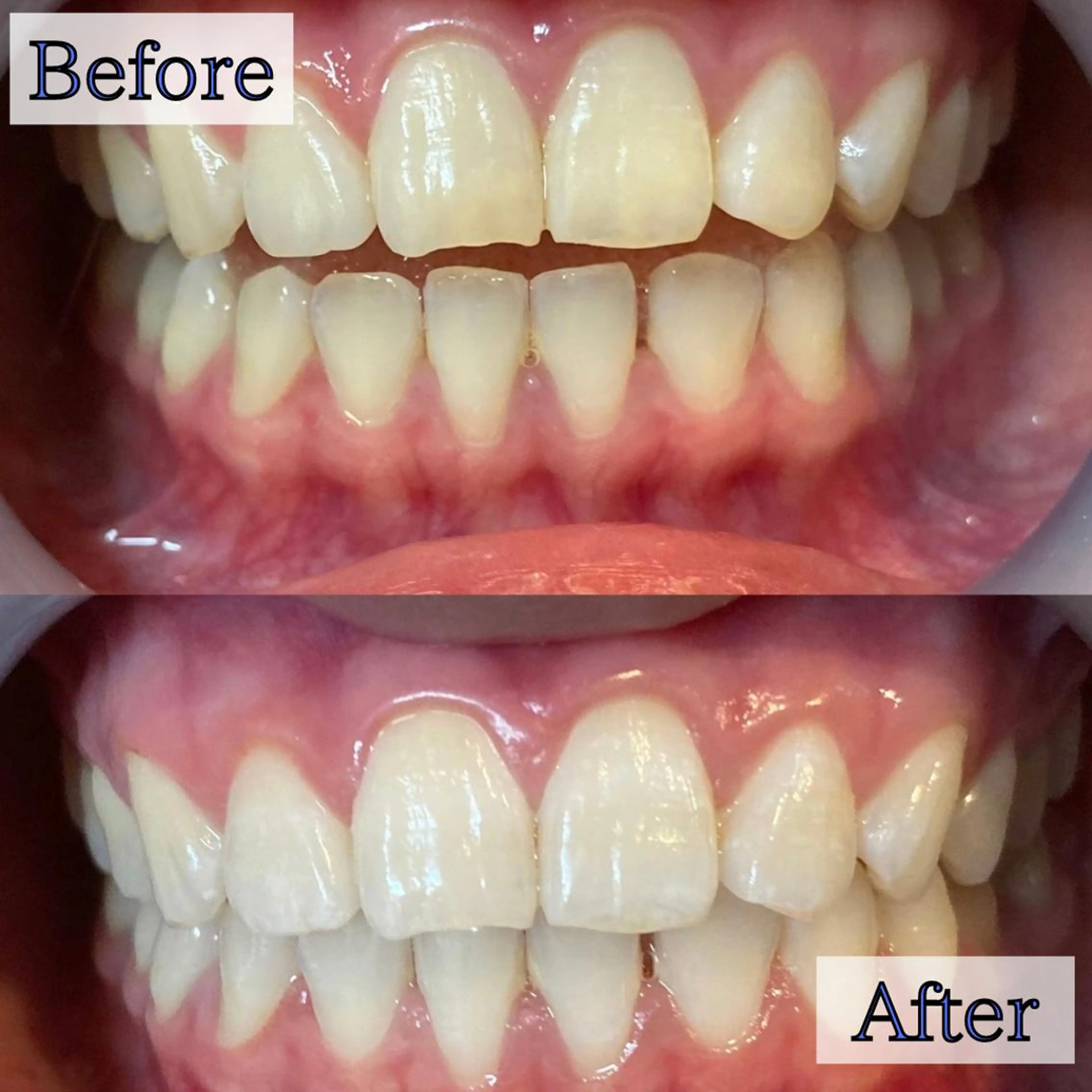 【人気No.1】5分照射×2回通常の約2倍の照射パワー‼ハイパワーセルフホワイトニングの写真