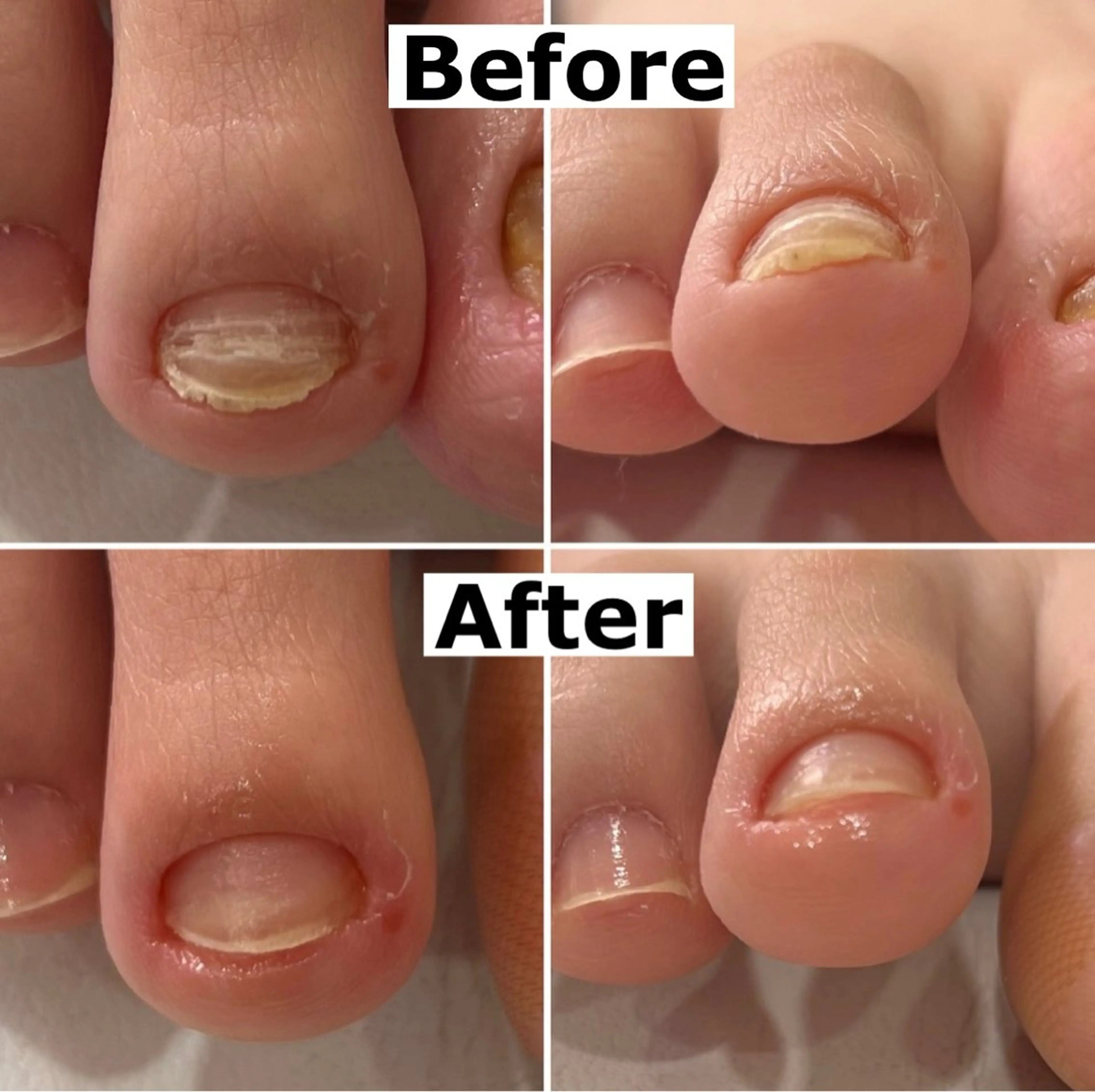 ネイル 巻爪無料モデル募集 ✨🦶MEGUMIのネイルデザイン