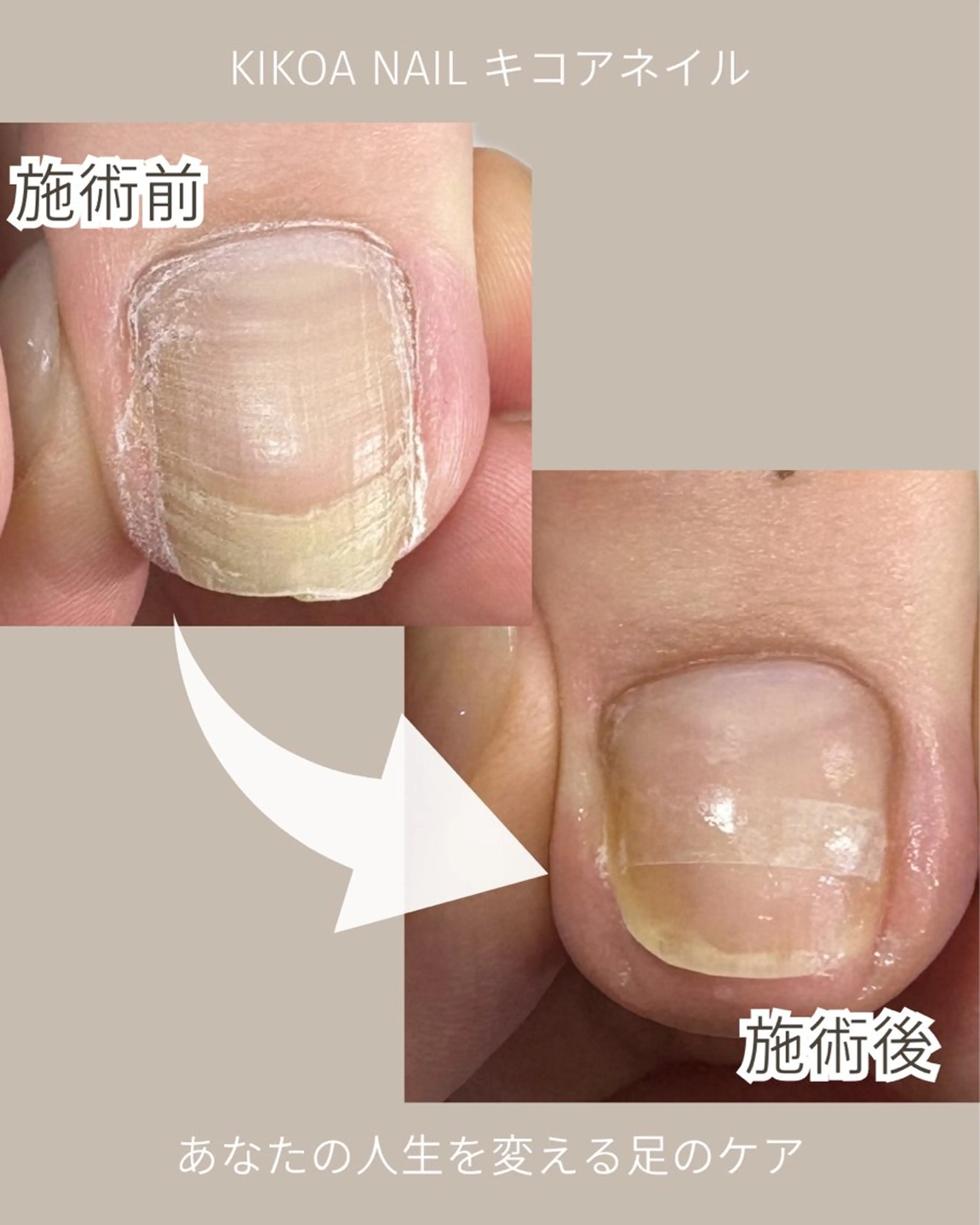 ネイル フットネイル KIKOA NAIL キコアネイルのネイルデザイン