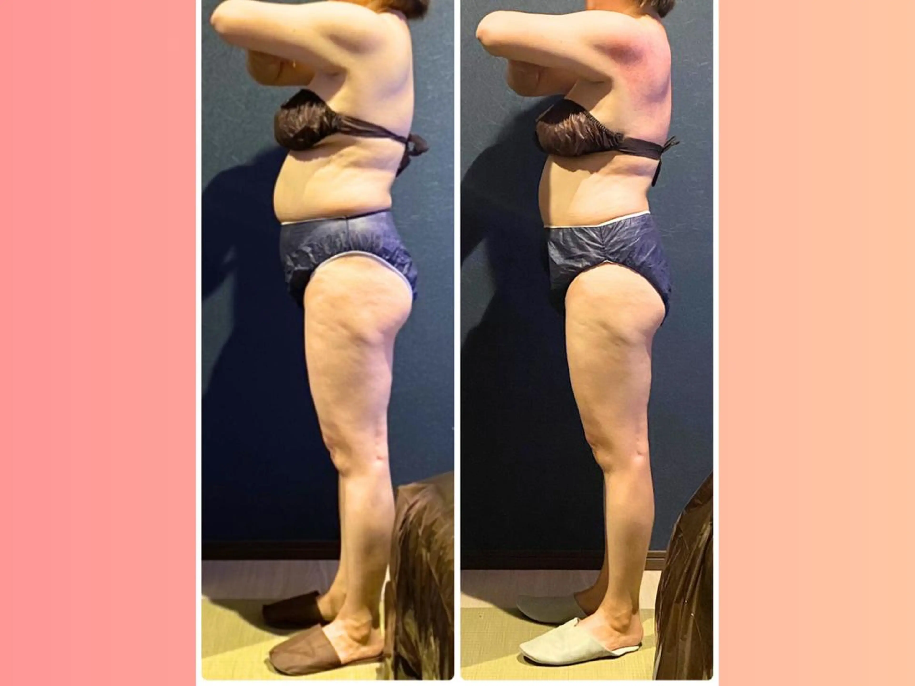 期間限定【集中特化】ハイパーナイフ痩身+筋膜リリース60分8800円の写真