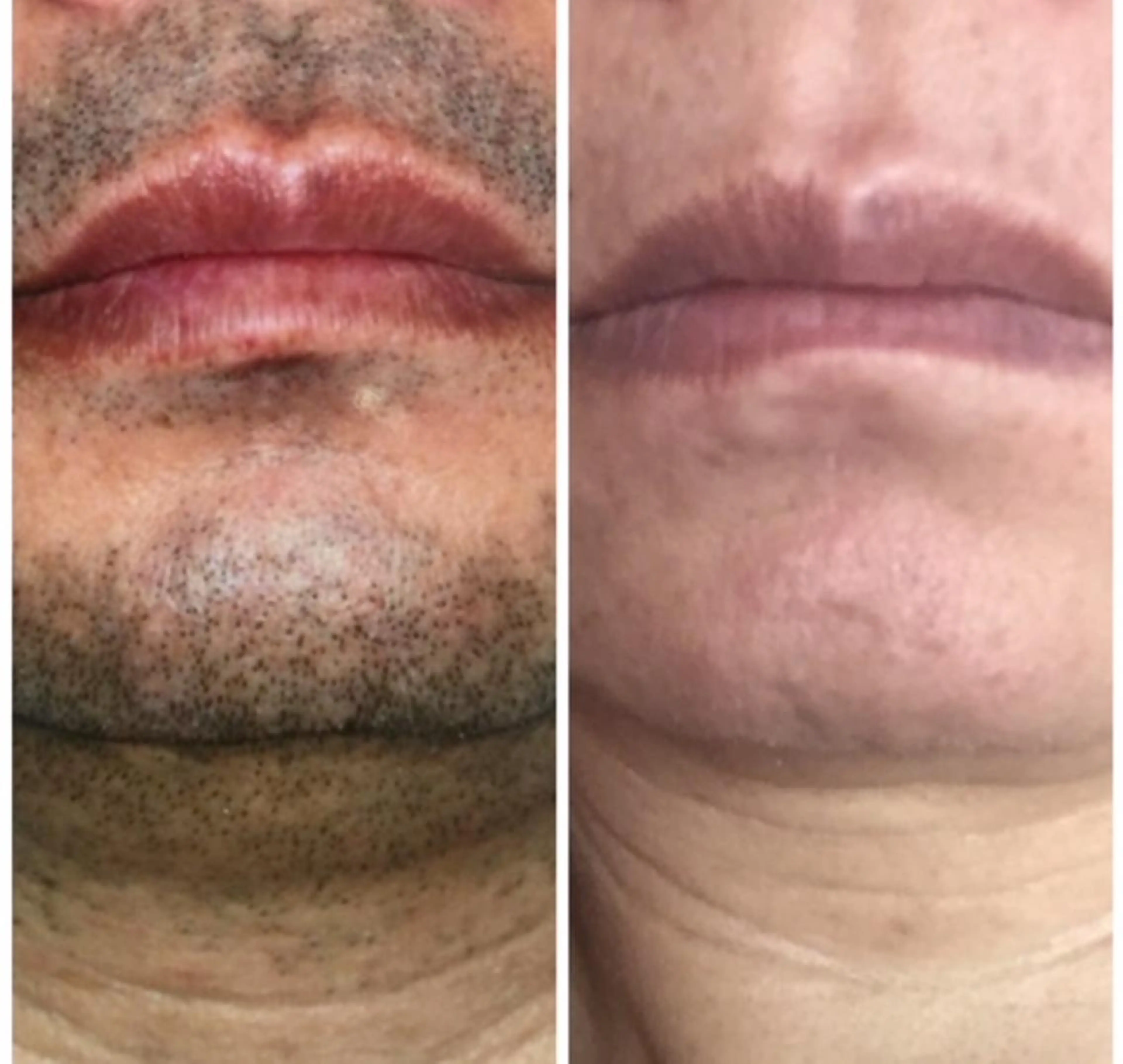 脱毛・ハイフ ・フェアリーのエステ・リラクイメージ