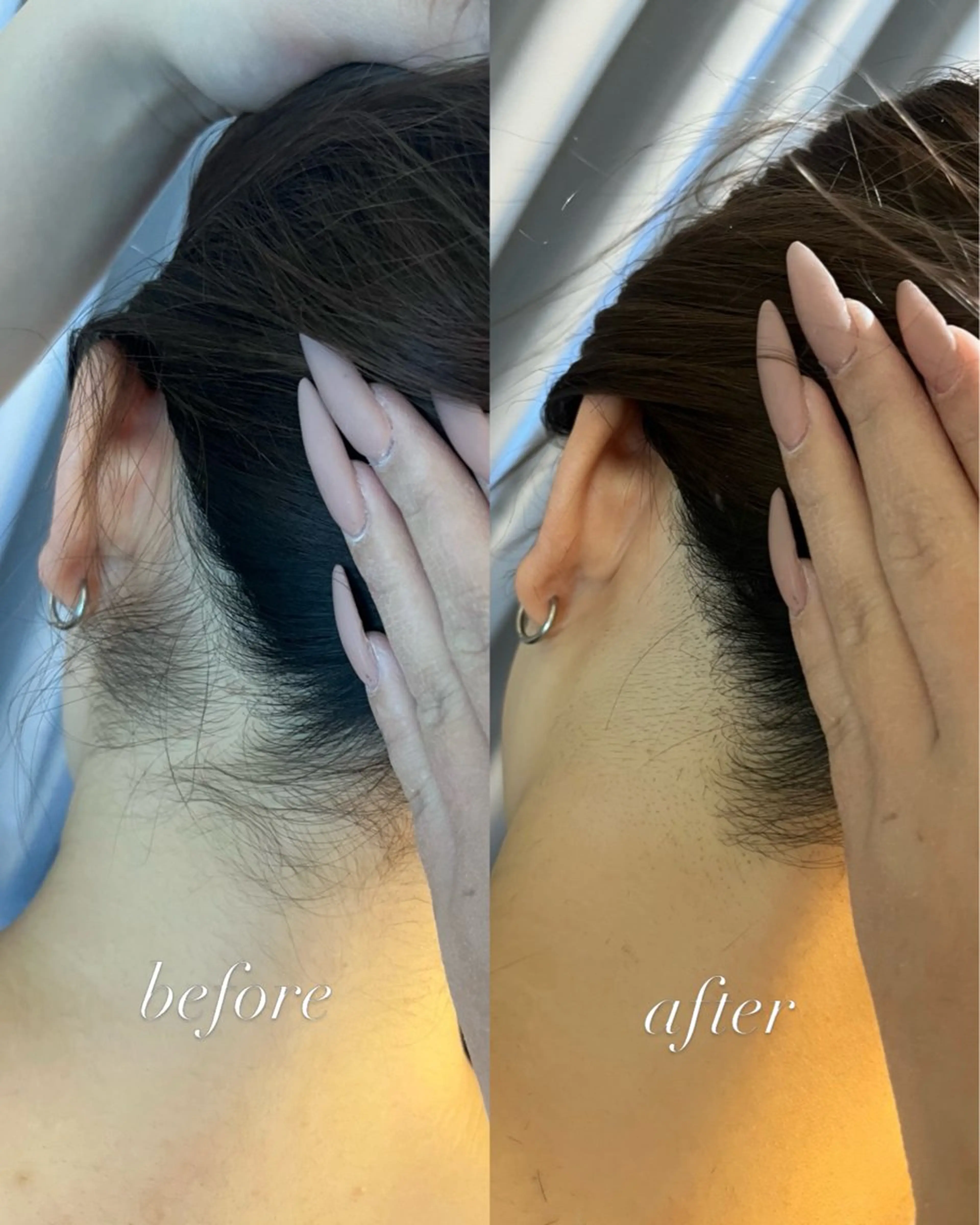 脱毛 うなじ脱毛/美肌脱毛 LABELのエステ・リラクイメージ