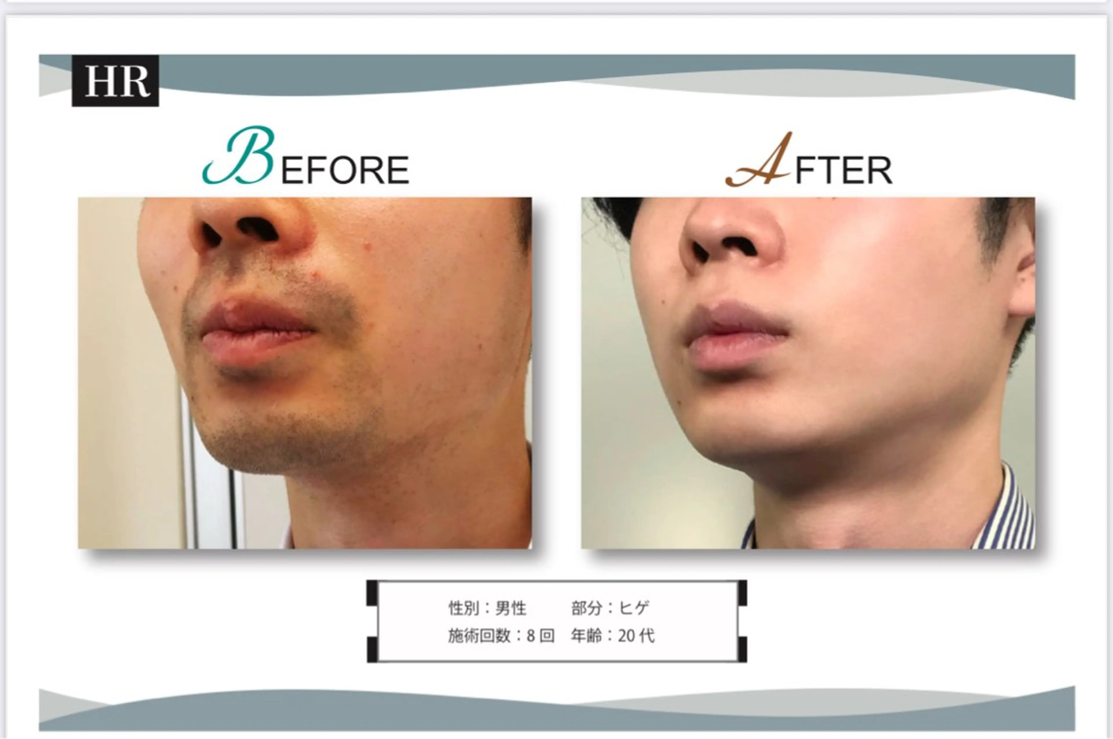 【men'sメニュー】お試し　ヒゲ脱毛の写真