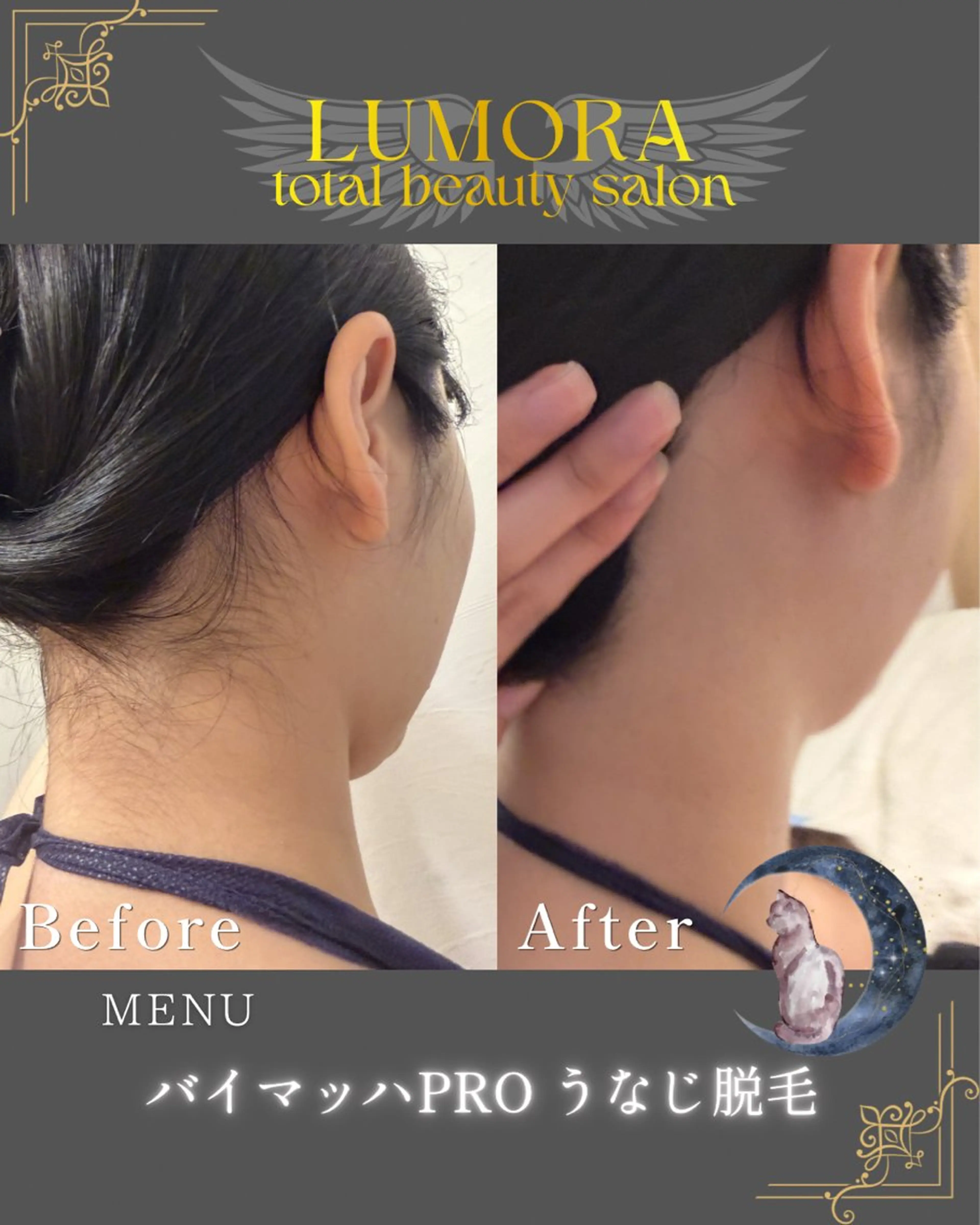 【うなじ脱毛】ブライダル・成人式・前撮り前に🤍🕊💗の写真