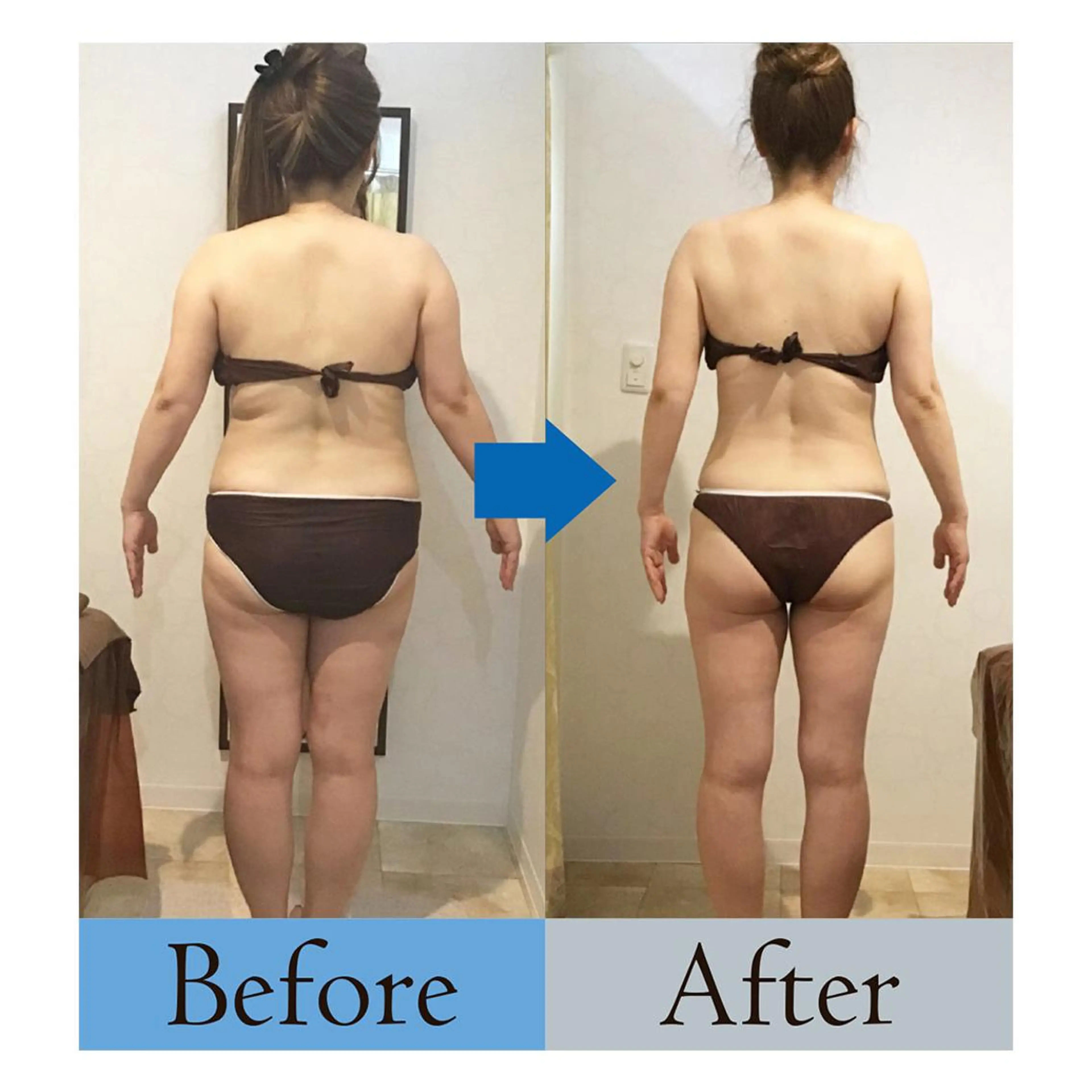 【痩身マシンで脂肪にアタック】2パーツ上限ショット照射&揉み出し発汗の写真