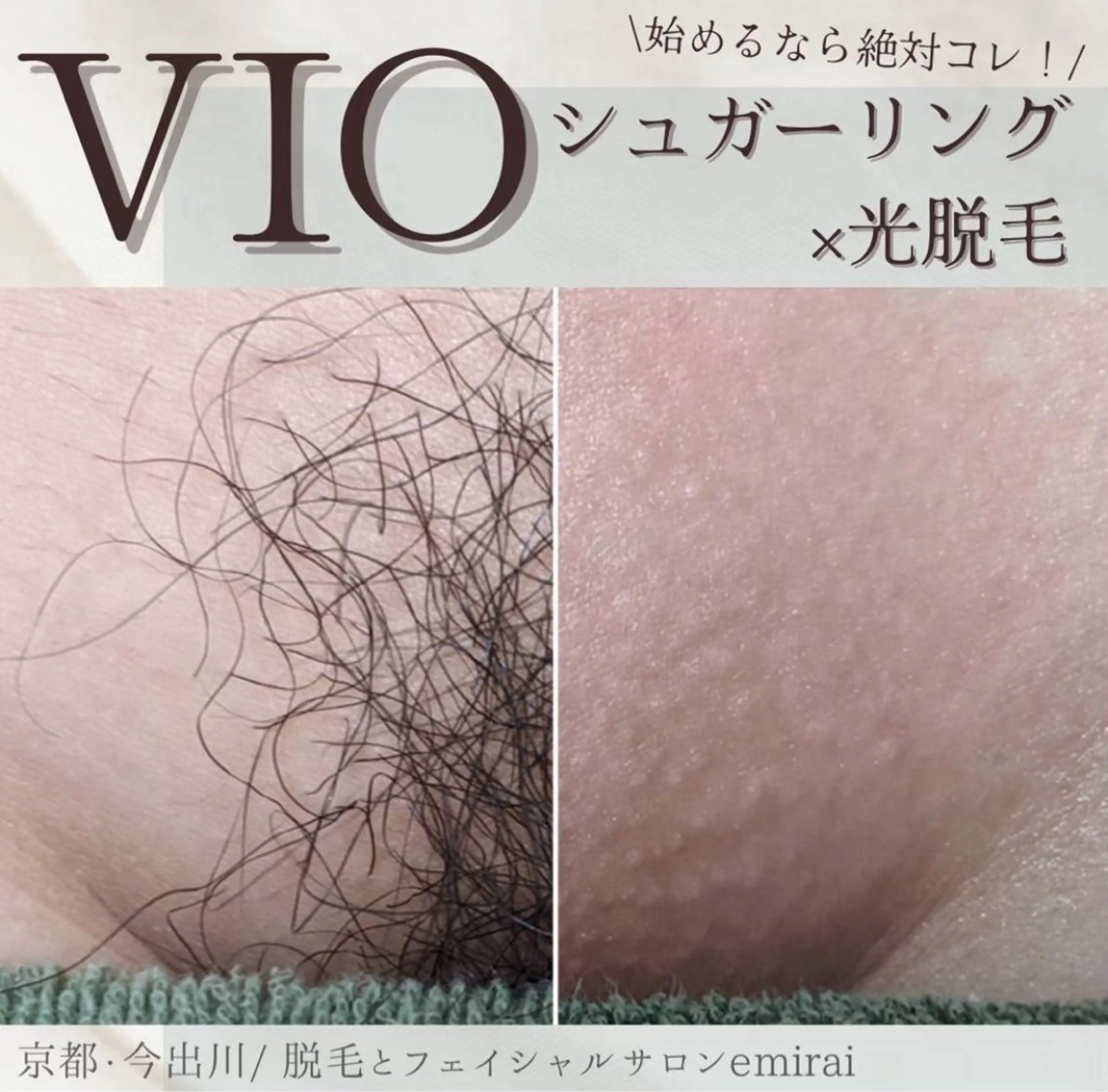 人気Ｎｏ.1✨シュガーリング🍯+最新式光脱毛✨で当日からつるつる！チクチクしないVIOmix脱毛🍯💕の写真