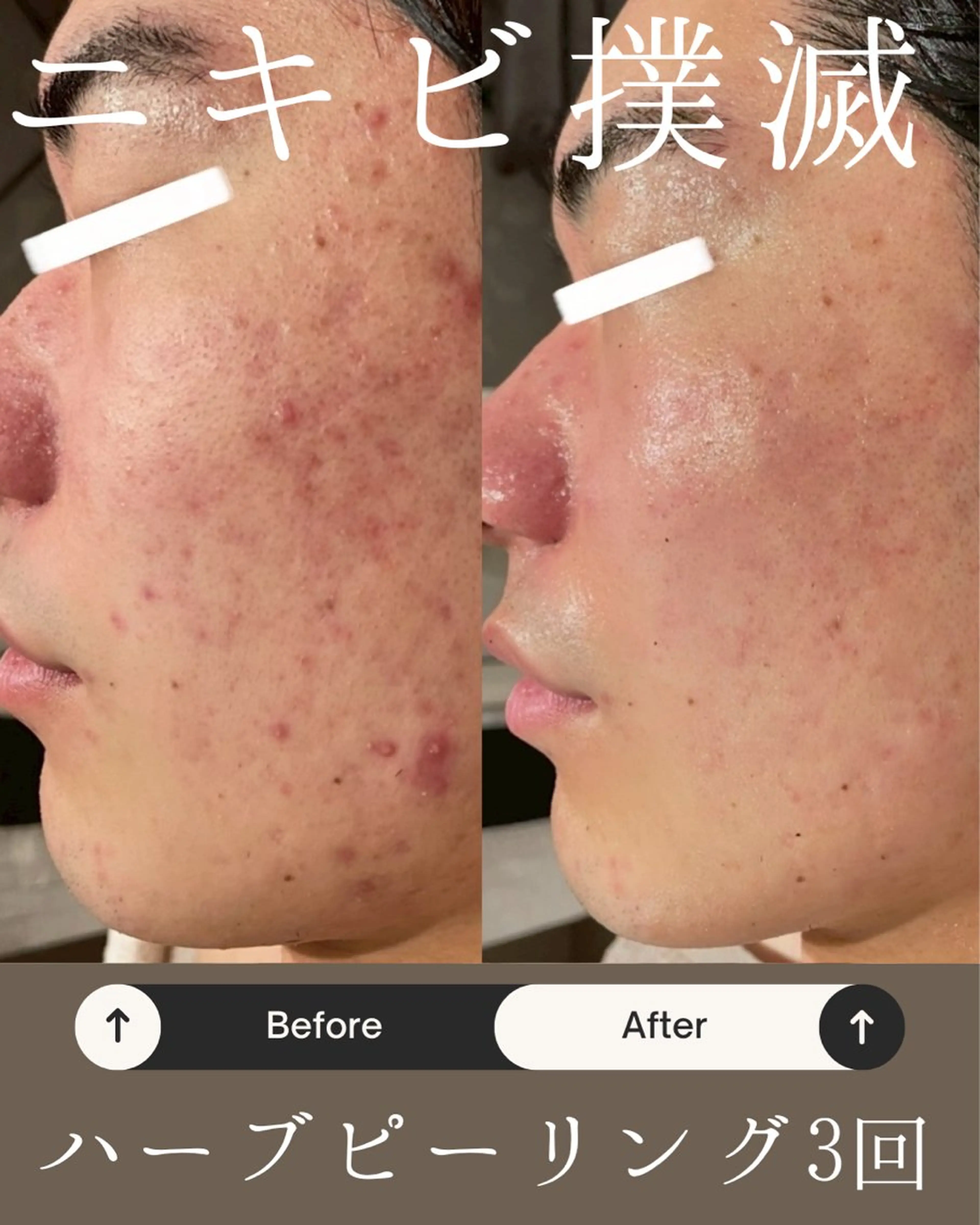 Anpawman ハーブピーリング専門のエステ・リラクイメージ