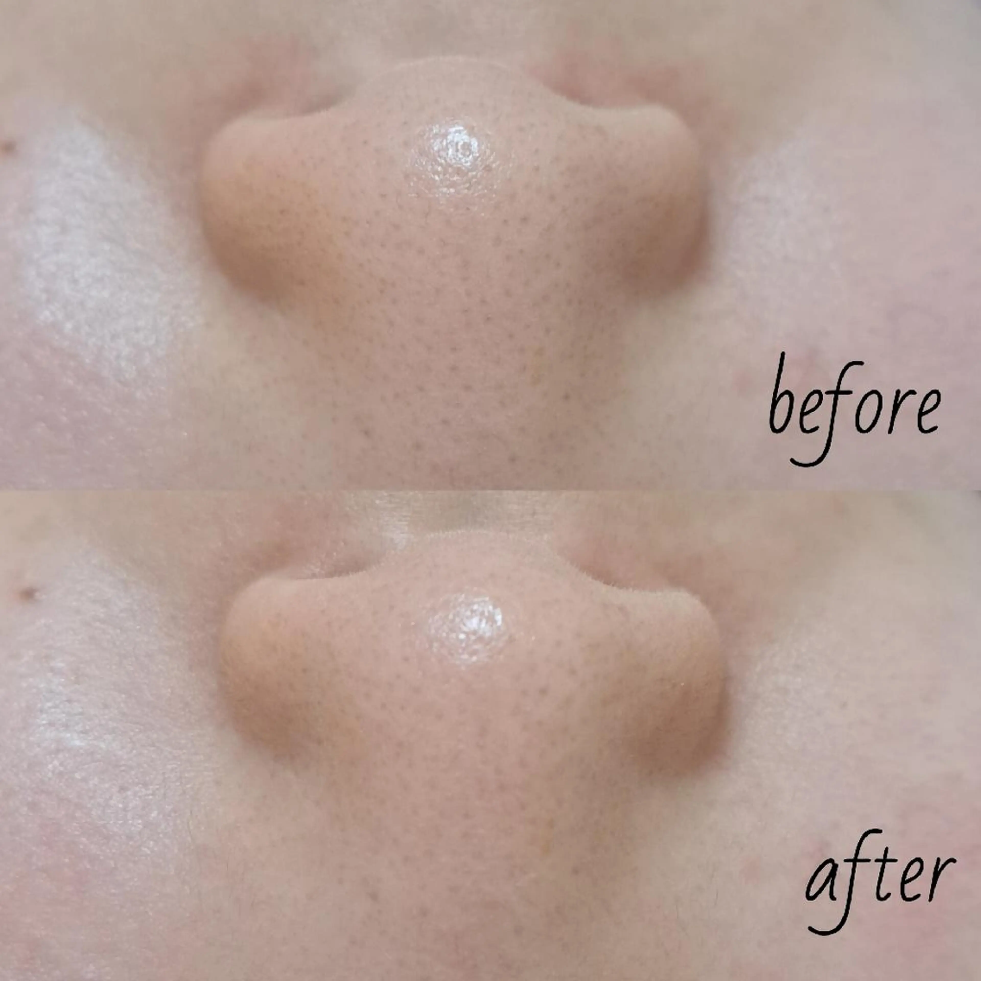 【男性限定メニュー】毛穴洗浄コース+リンパマッサージの写真