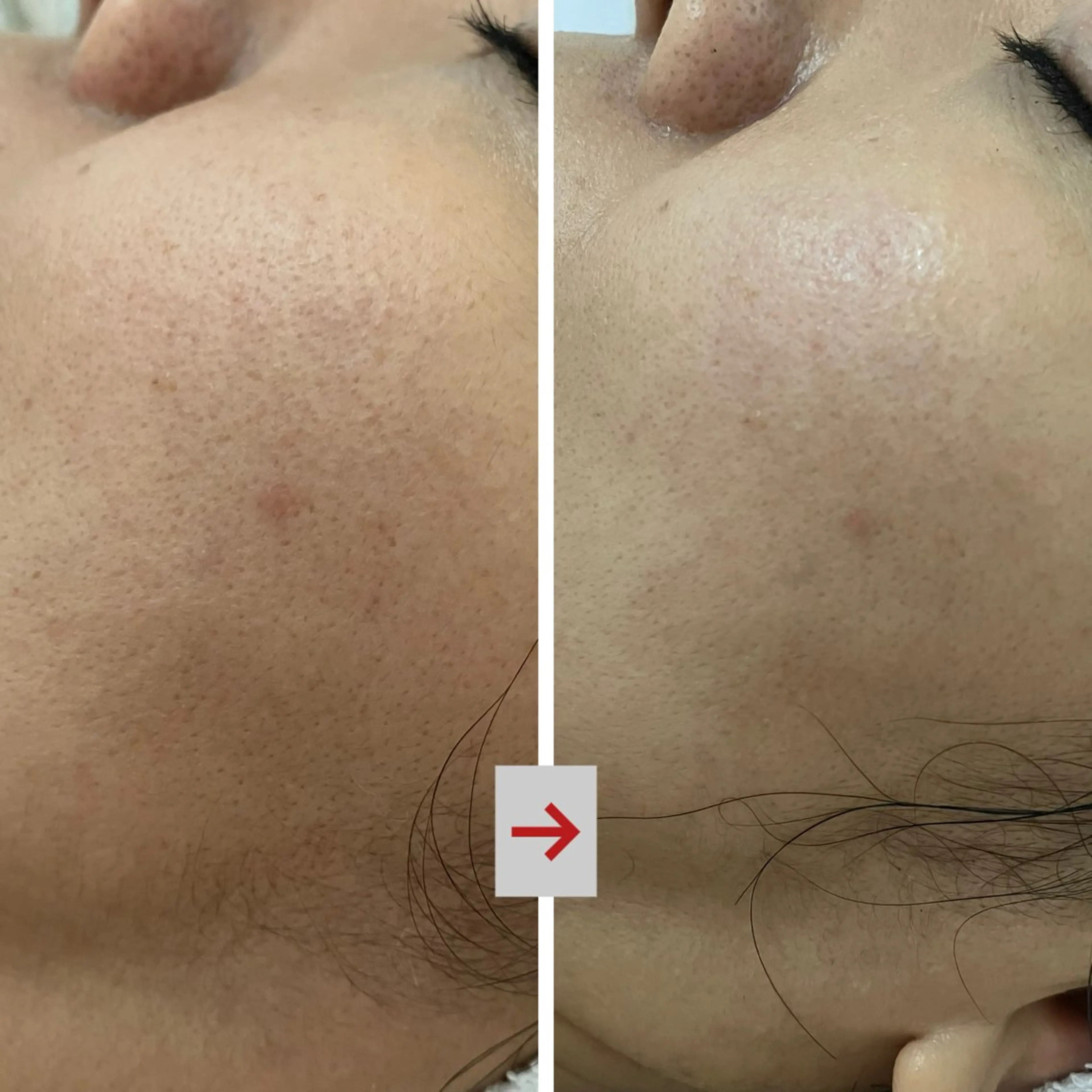 完璧肌を目指すなら！【プレミアムハーブピーリング】¥22000→￥１１０００の写真