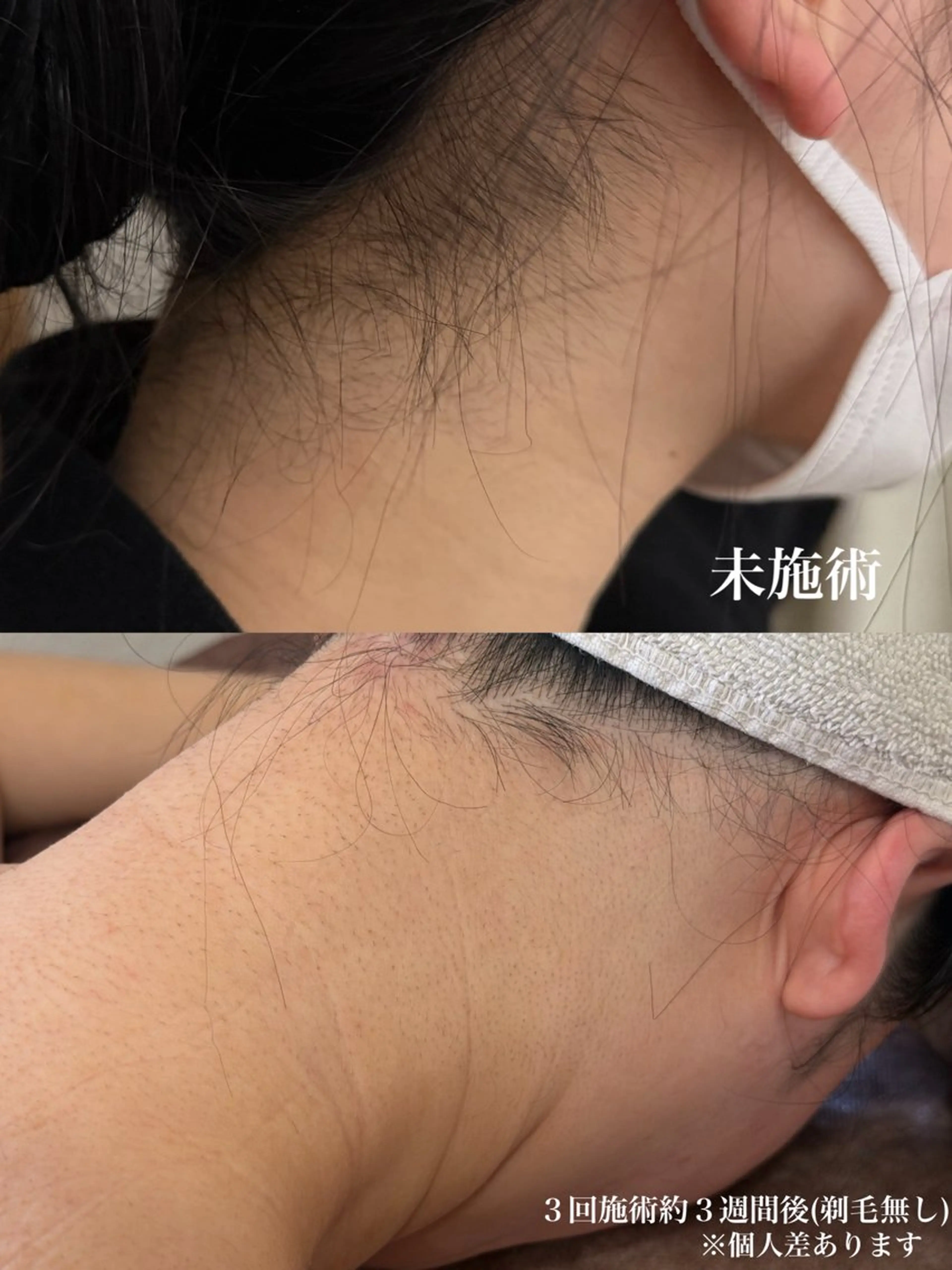 脱毛 muumo まりののエステ・リラクイメージ