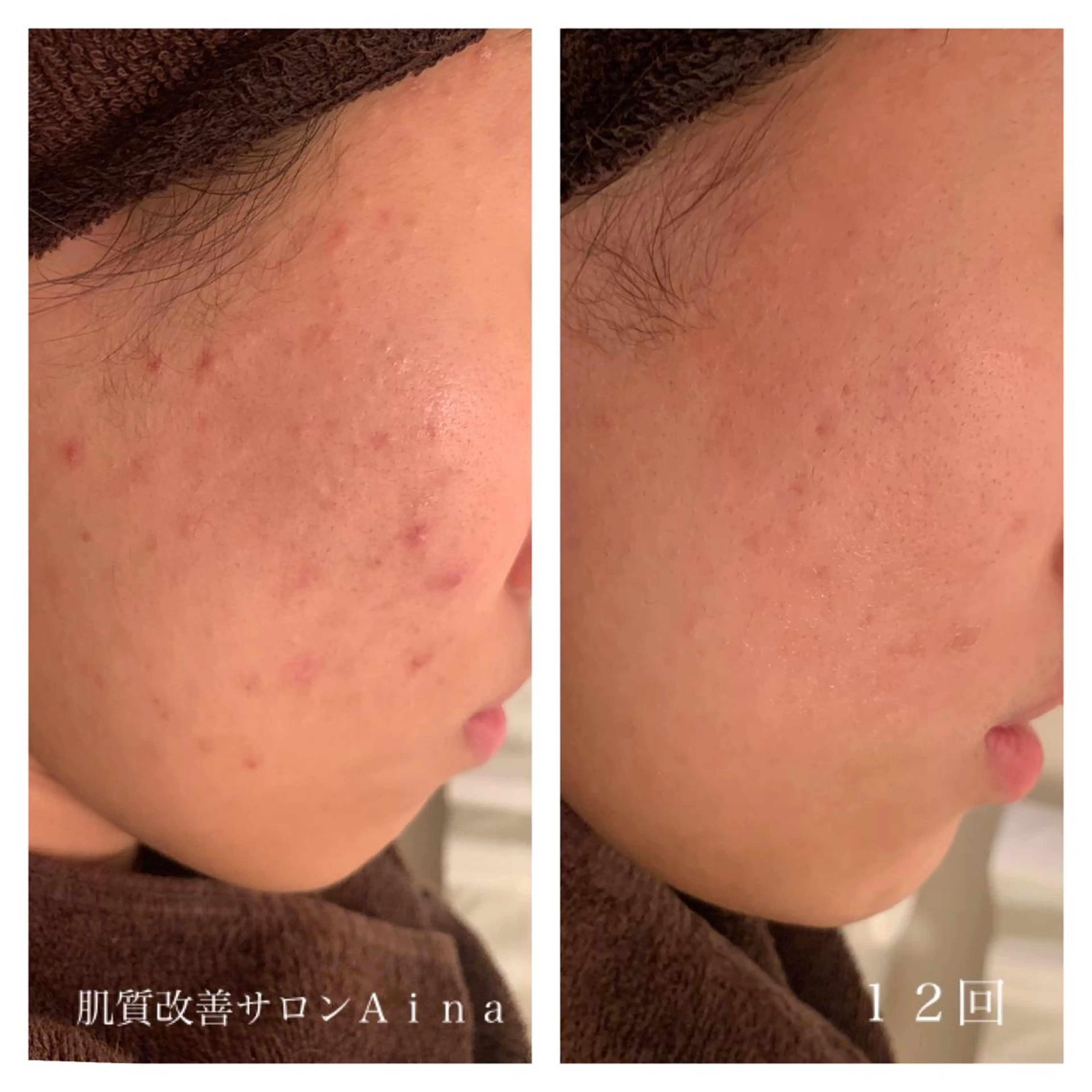 ミディアム カラー パーマ ヘアアレンジ メンズ キッズ ネイル マツエク・マツパ エステ リラク ニキビ跡専門サロン Ａｉｎａのエステ・リラクイメージ