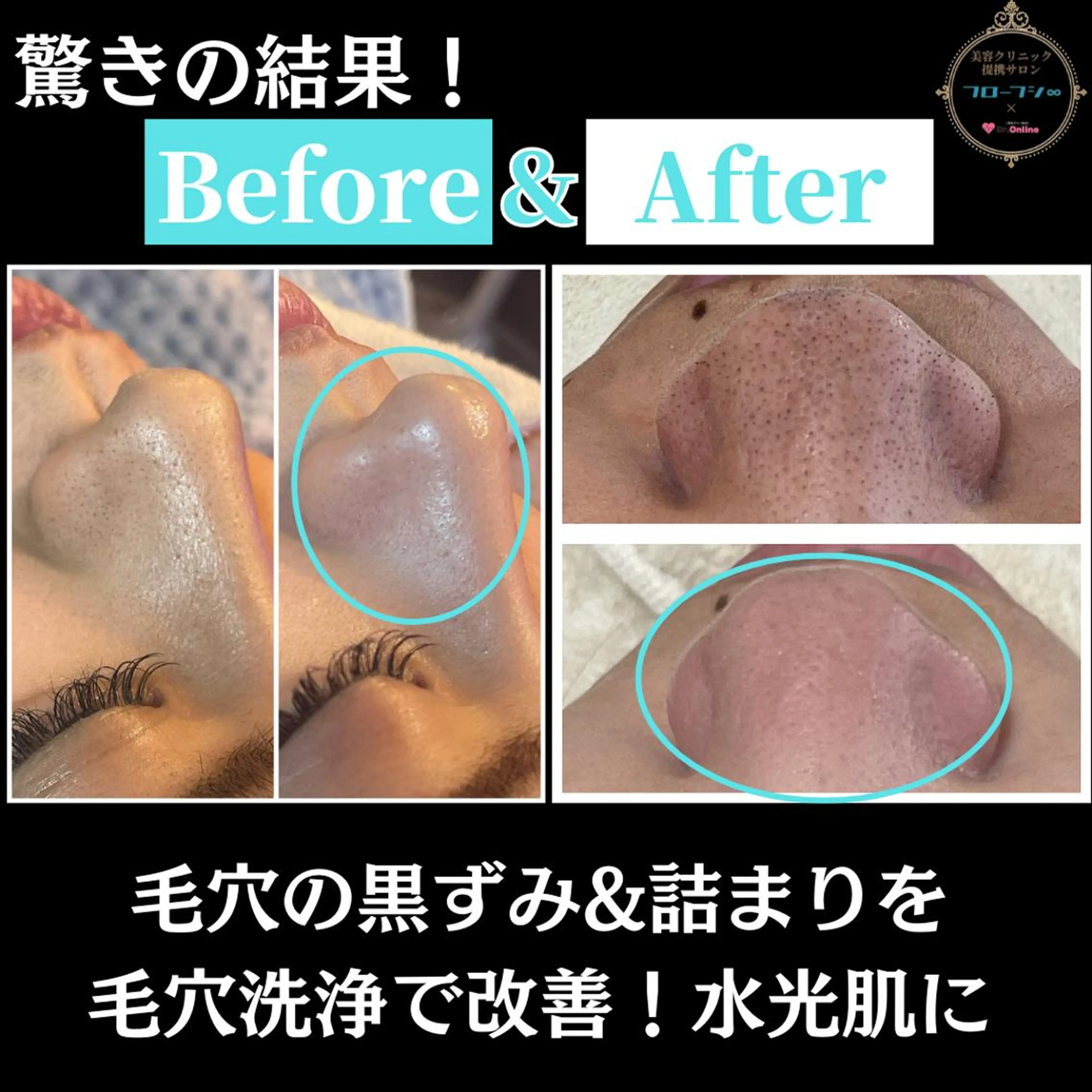 エステ フローフシ∞💙 毛穴洗浄で毛穴レスのエステ・リラクイメージ