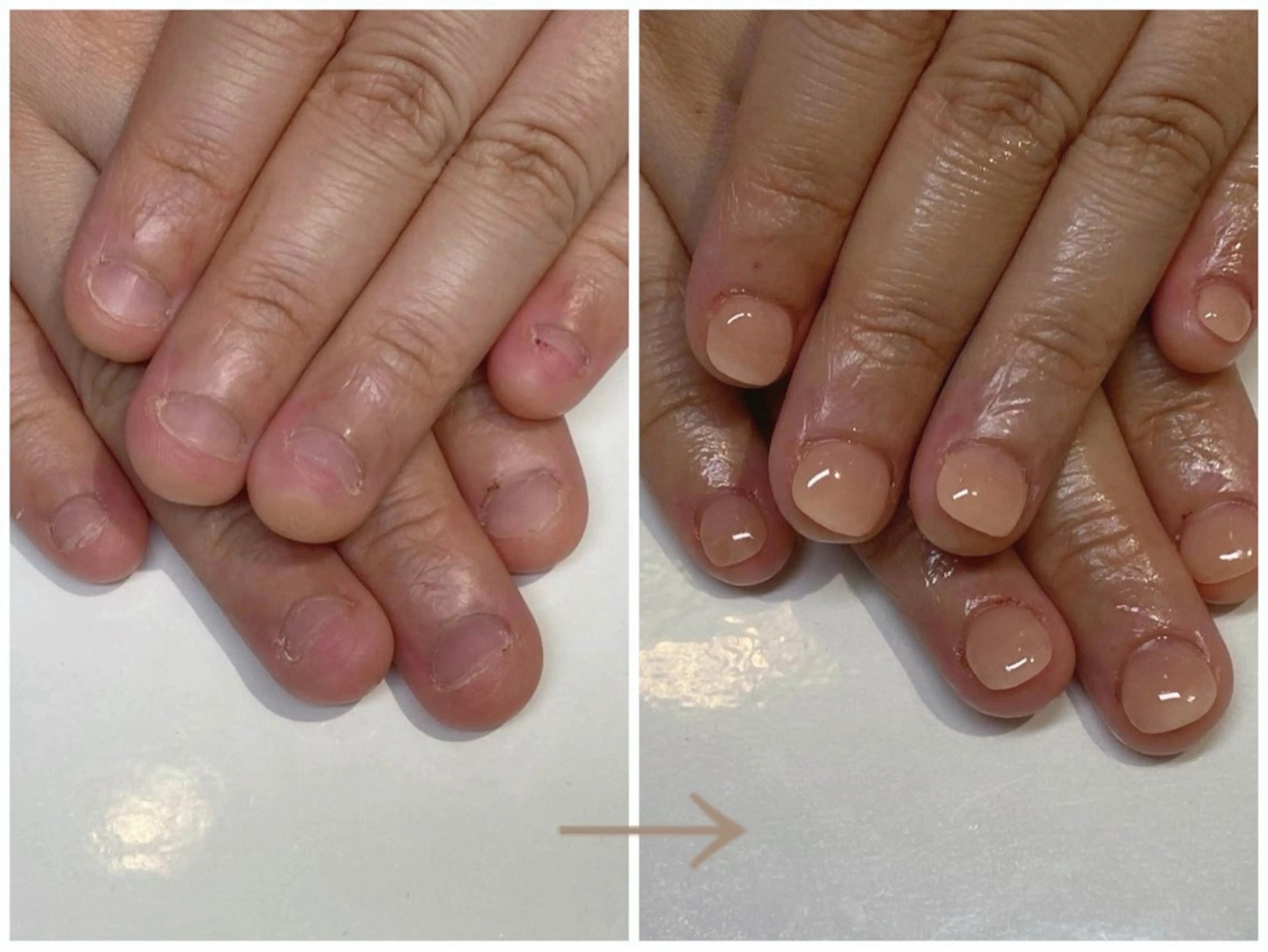 リピーター様用【ハンド深爪の方限定】再発させない深爪矯正お試し1回　ワンカラー仕上げの写真