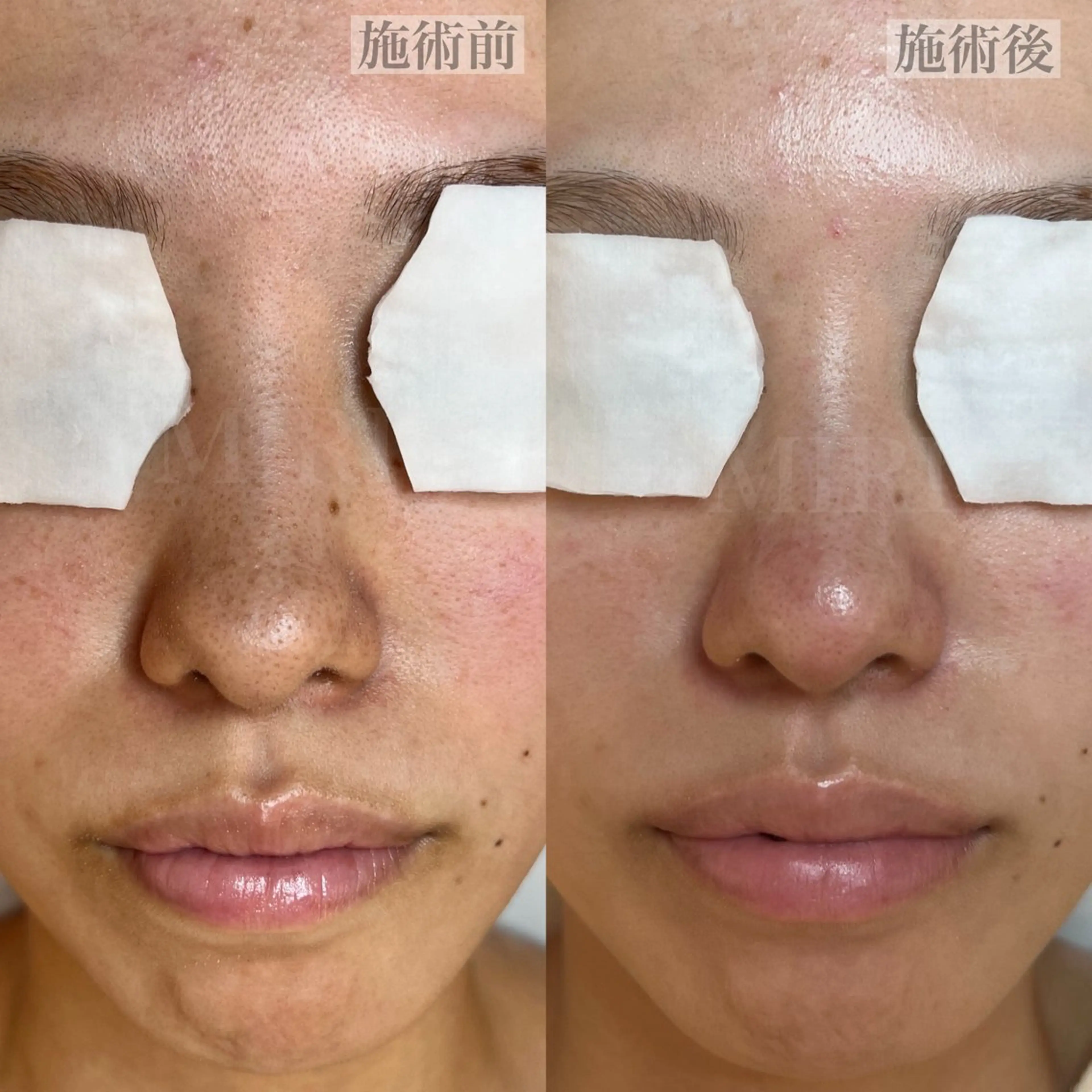 MIRI所属・北堀江/毛穴改善専門 ミリのエステ・リラクイメージ