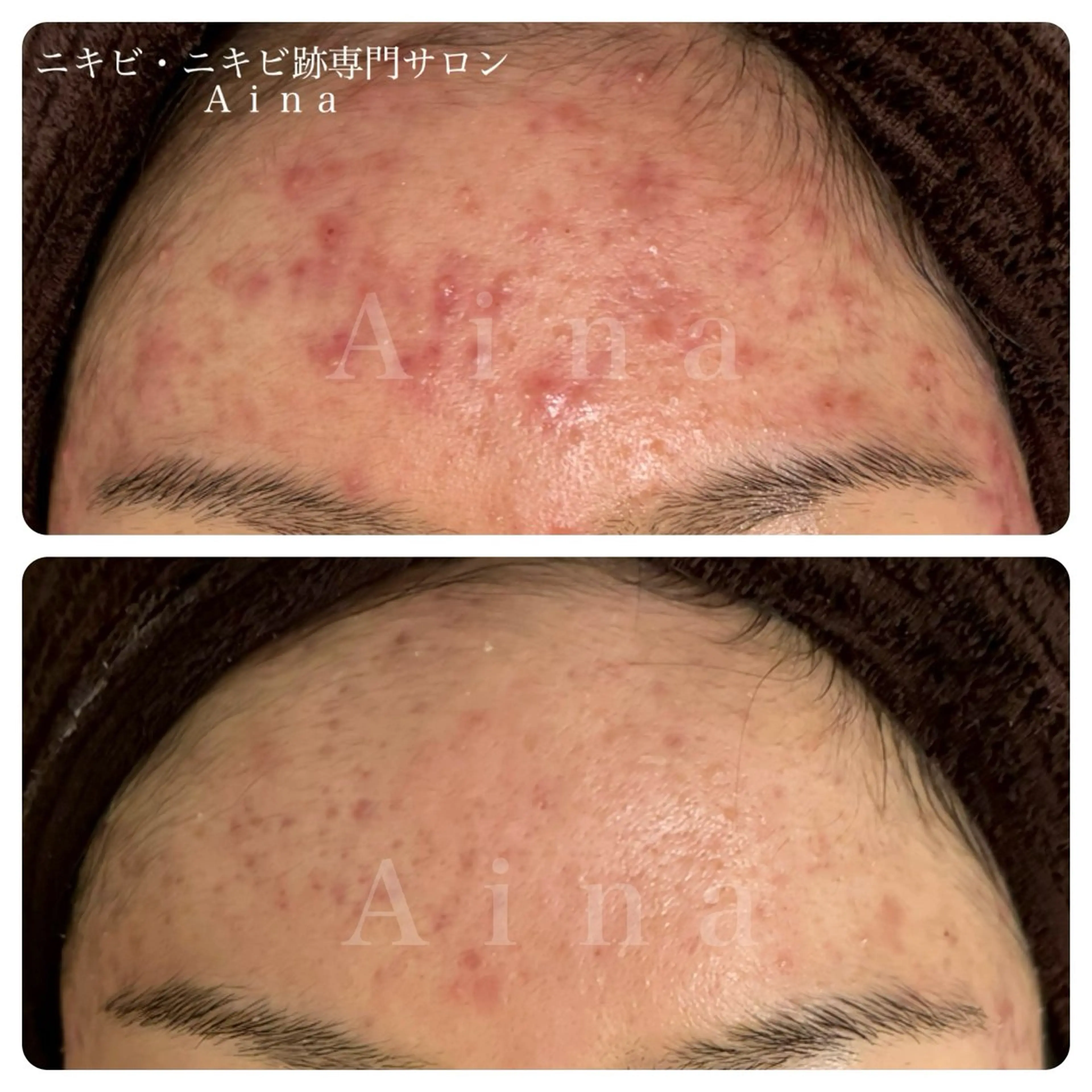 エステ リラク ニキビ跡専門サロン Ａｉｎａのエステ・リラクイメージ