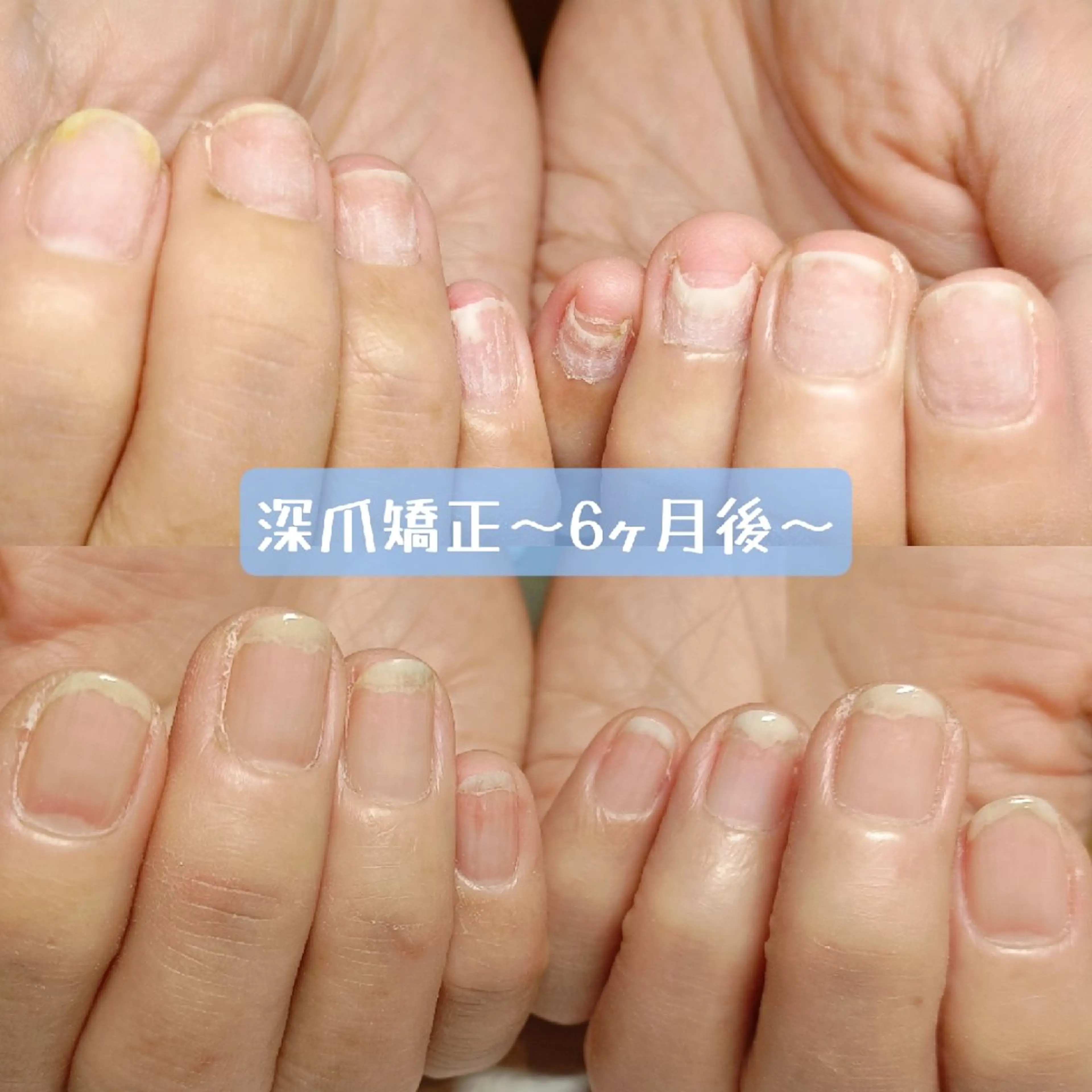 ネイル ピンク ハンドネイル ハンドケア 深爪矯正/爪育成ケア manie nailのネイルデザイン