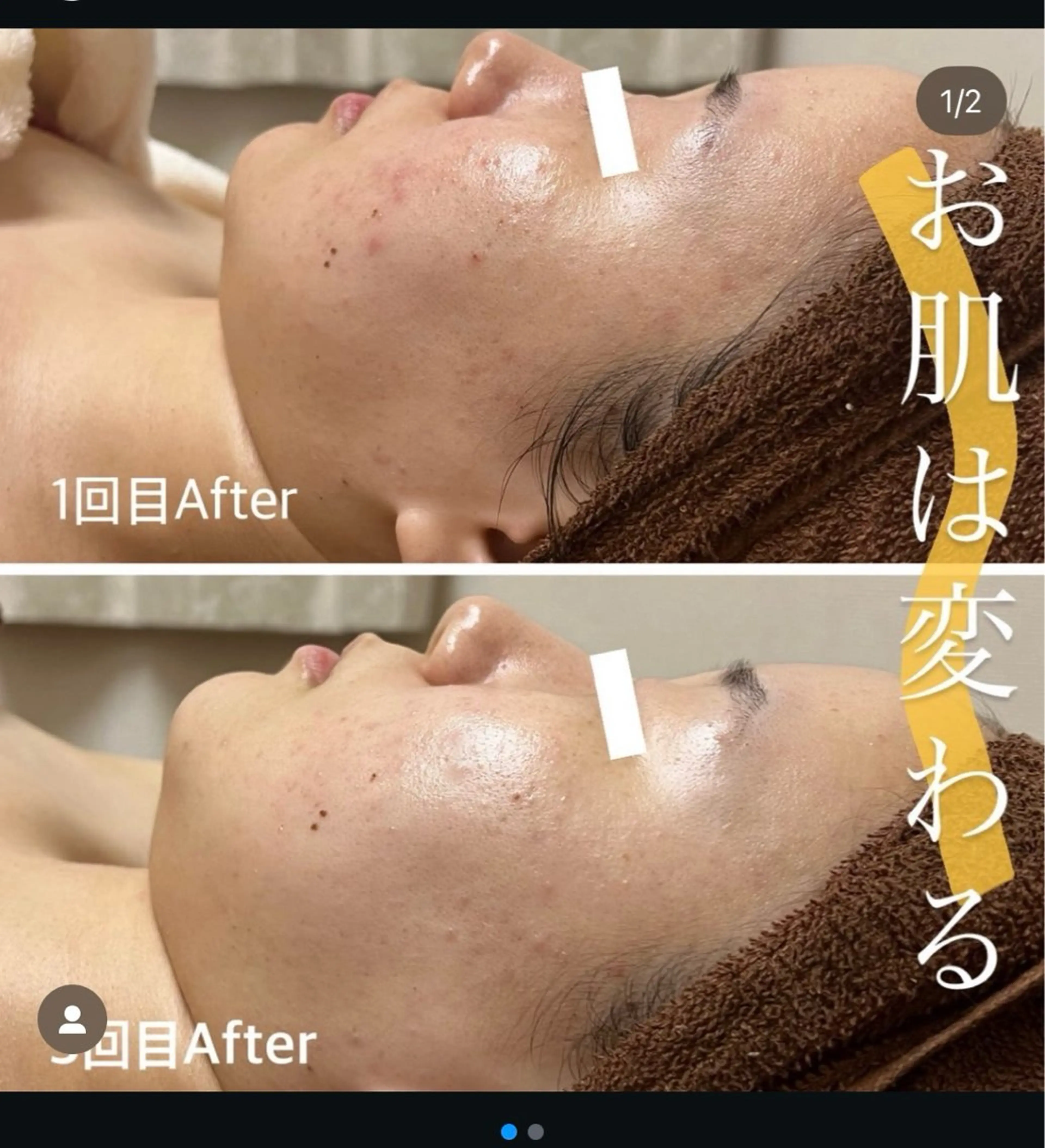 〈お顔〉ハーブピーリング【ニキビ.毛穴.シミケア】🌿,,の写真