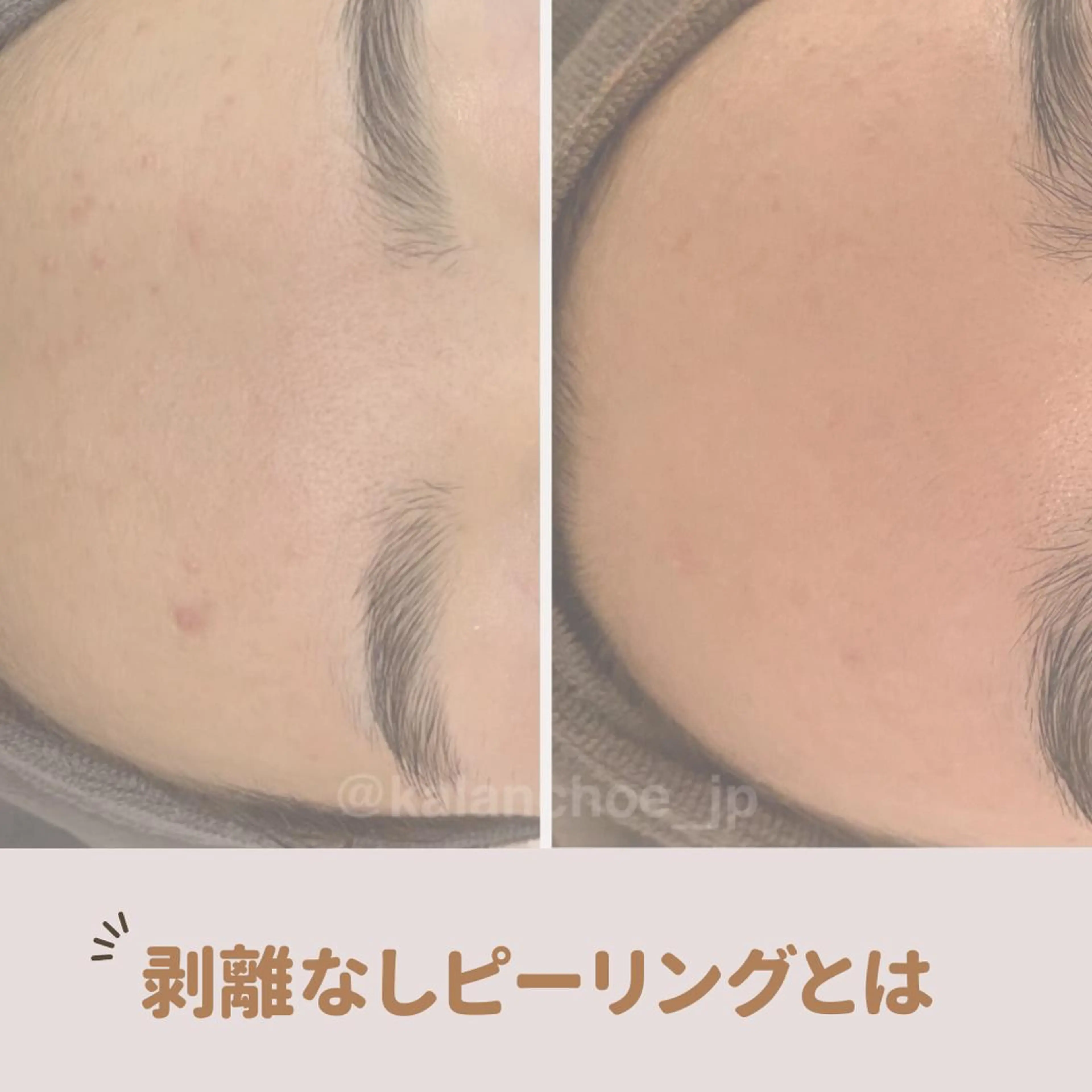 エステ 肌質改善 KALANCHOEのエステ・リラクイメージ