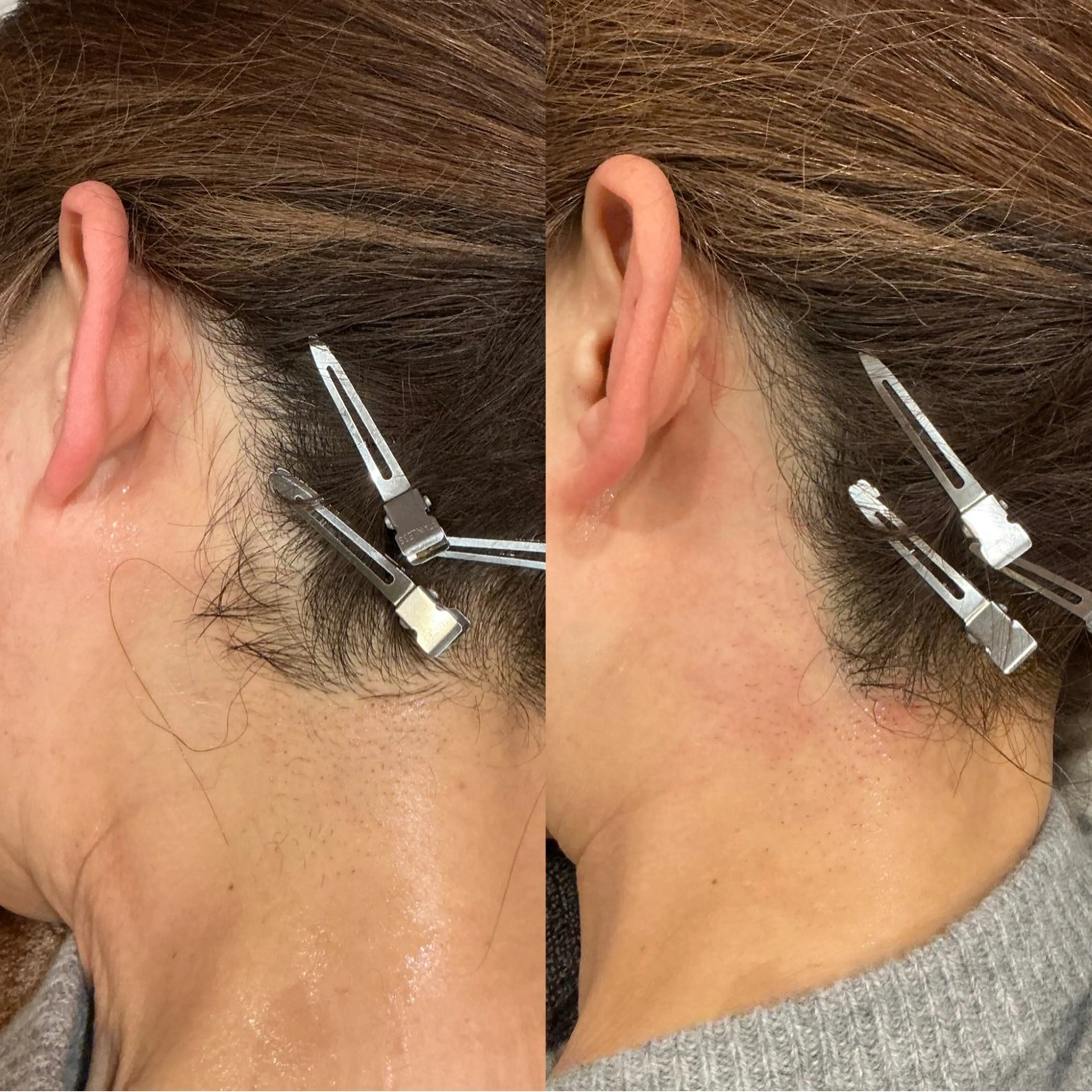 【脱毛】襟足マツヤニの写真