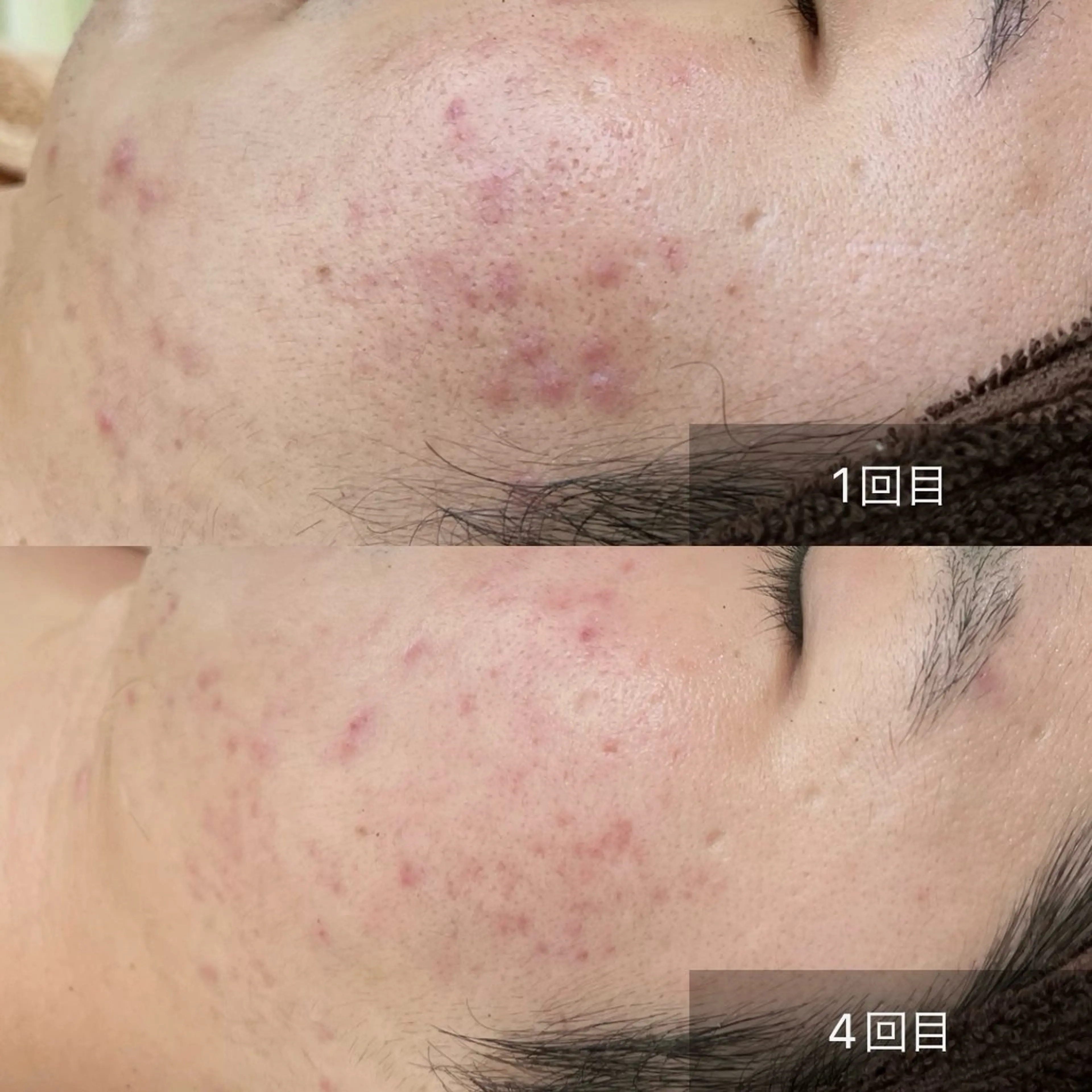 【繰り返しできるニキビにさよなら】ニキビでお悩みの方/ハーブピーリング🌿陶肌トリートメントの写真