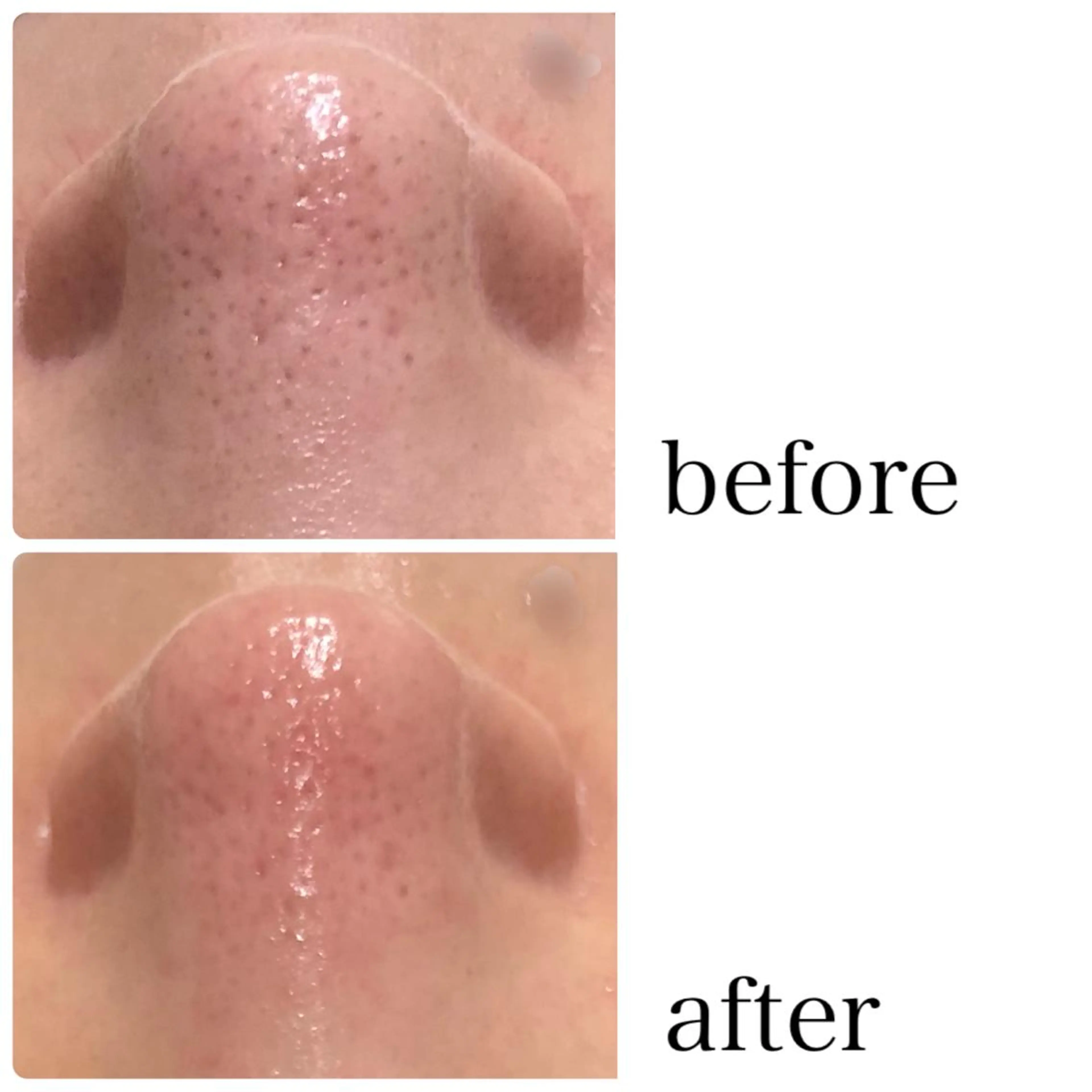 毎月10名様限定‼️【毛穴洗浄ハイドラ】新鮮な水素で洗浄と吸引で頑固な皮脂や角栓を一掃！の写真