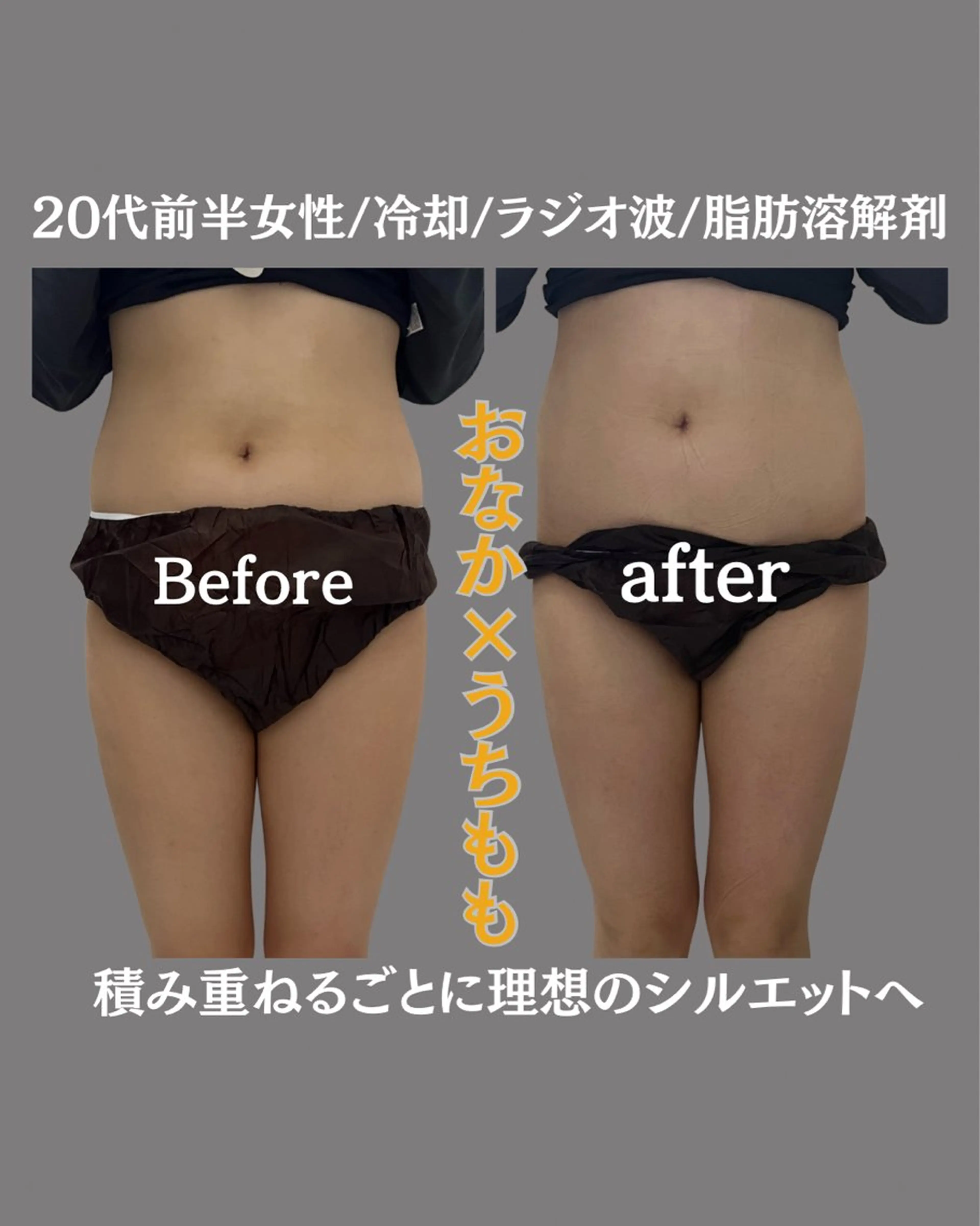 本気で痩せたいお腹【冷却ボディーケア4cup体験コース】 ダイエットサポートクリーム導入で即日効果実感！の写真