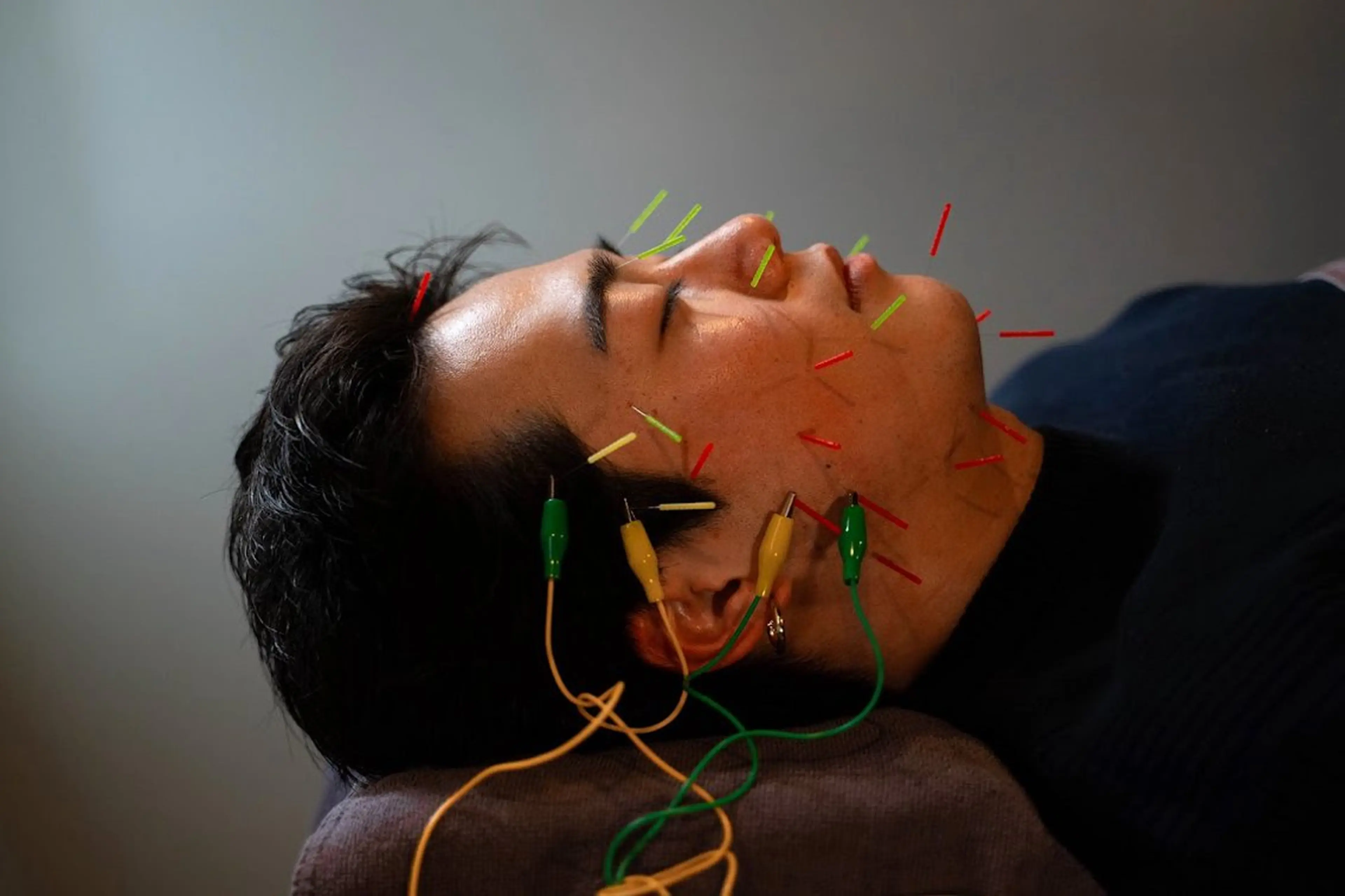 【学生限定🌸】短時間スキンアップ美容鍼　30分　¥5980 → ¥4980の写真