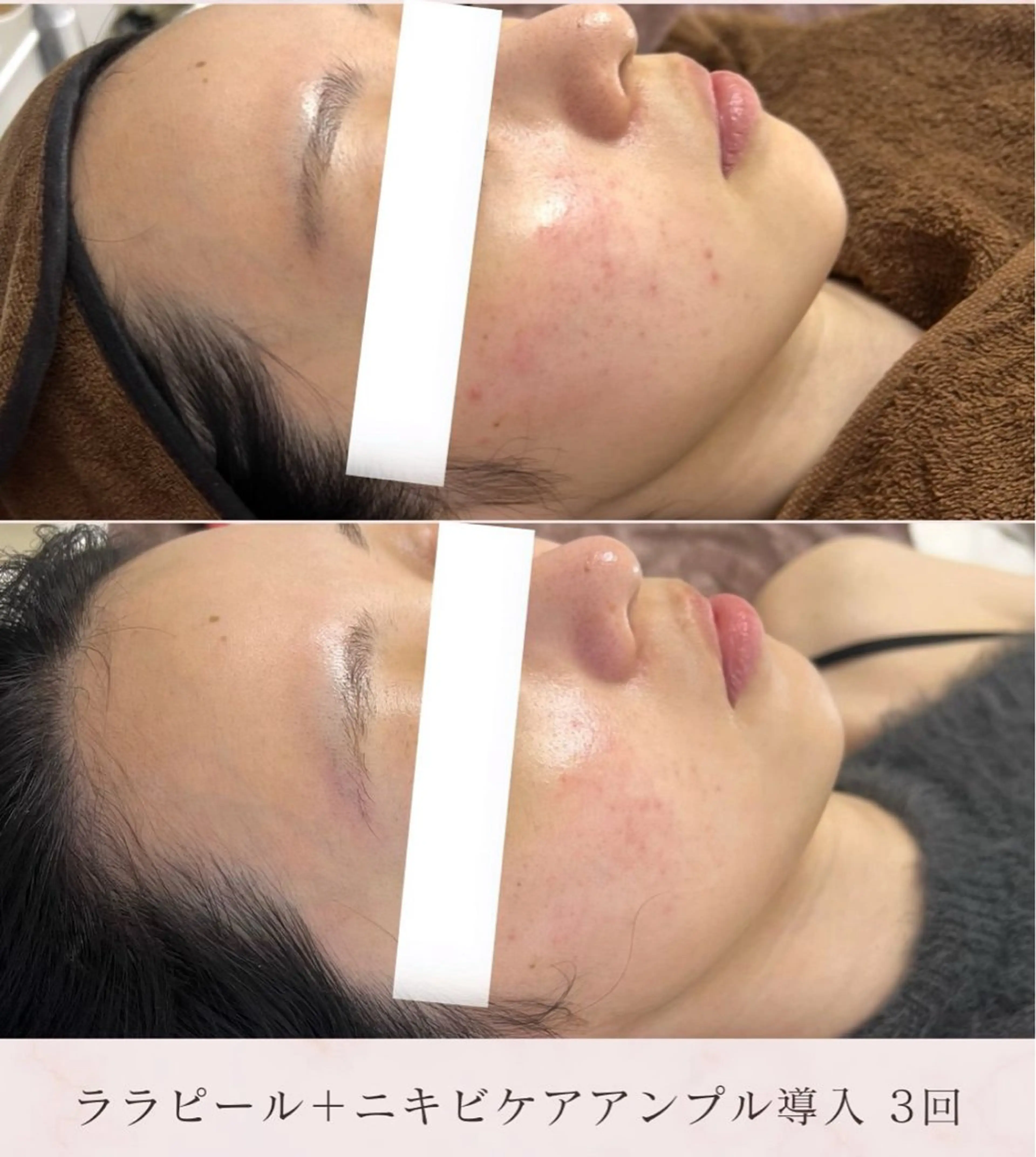 ララピール＋美容液導入で頑固なニキビ跡や繰り返すニキビ肌に優しくアプローチ💆‍♀️✨の写真