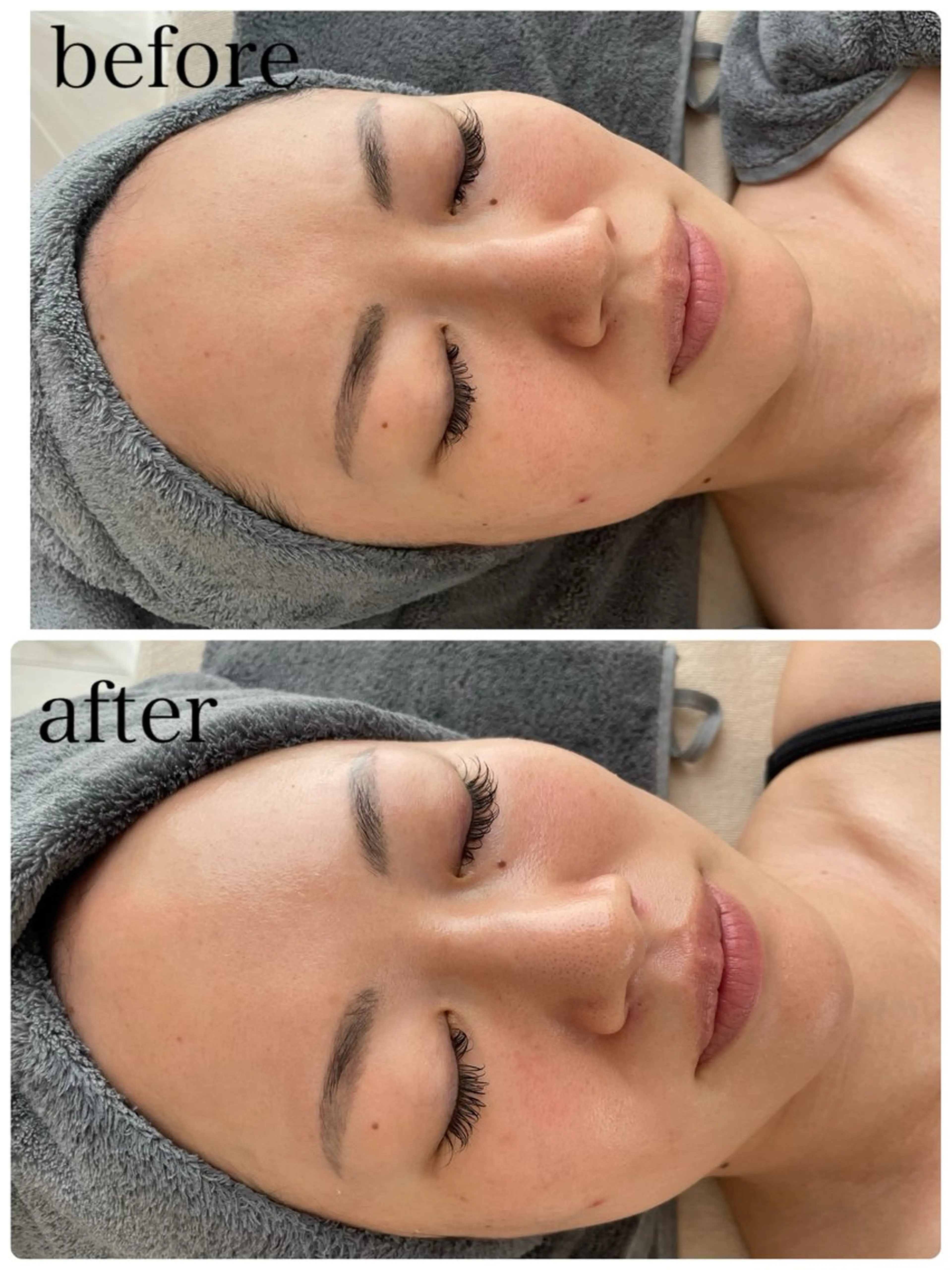 【韓国で話題のスペシャルケア】ララピール＋LDM水玉リフティングの写真