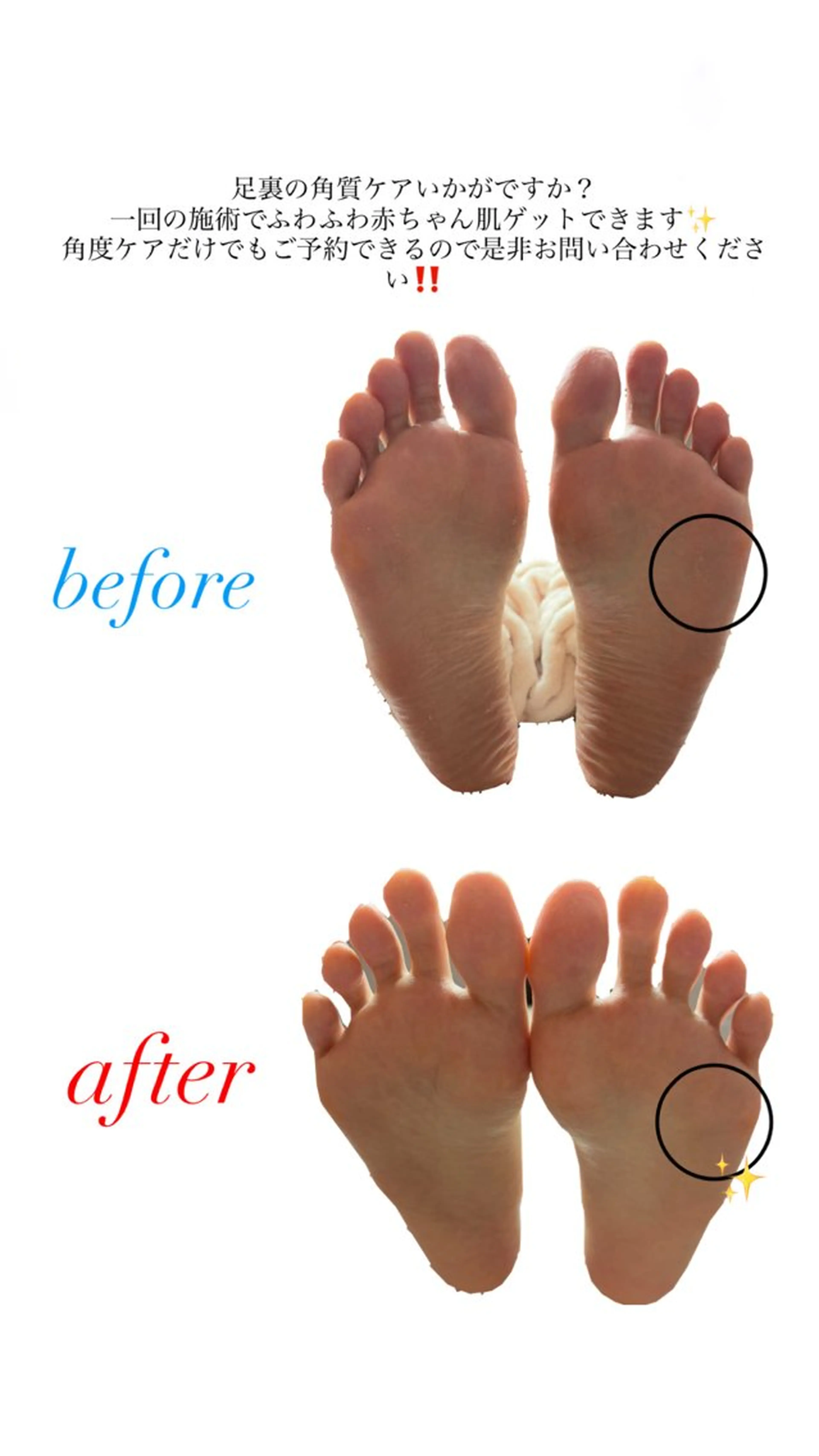 👣フット角質ケア👣の写真