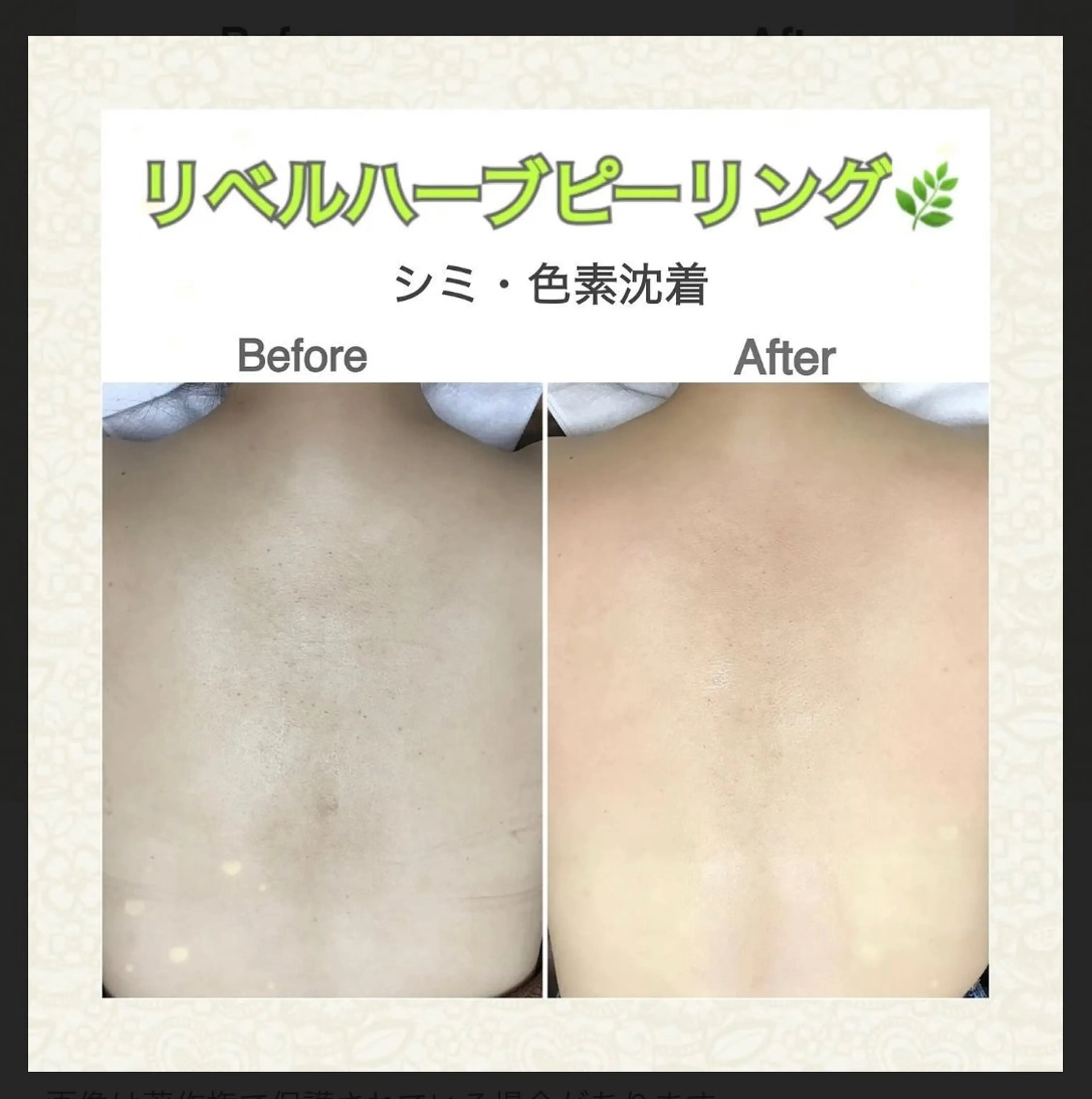 背中肌荒れ改善/毛穴ケア/ニキビケア/ザラツキ改善 リベルハーブピーリングの写真