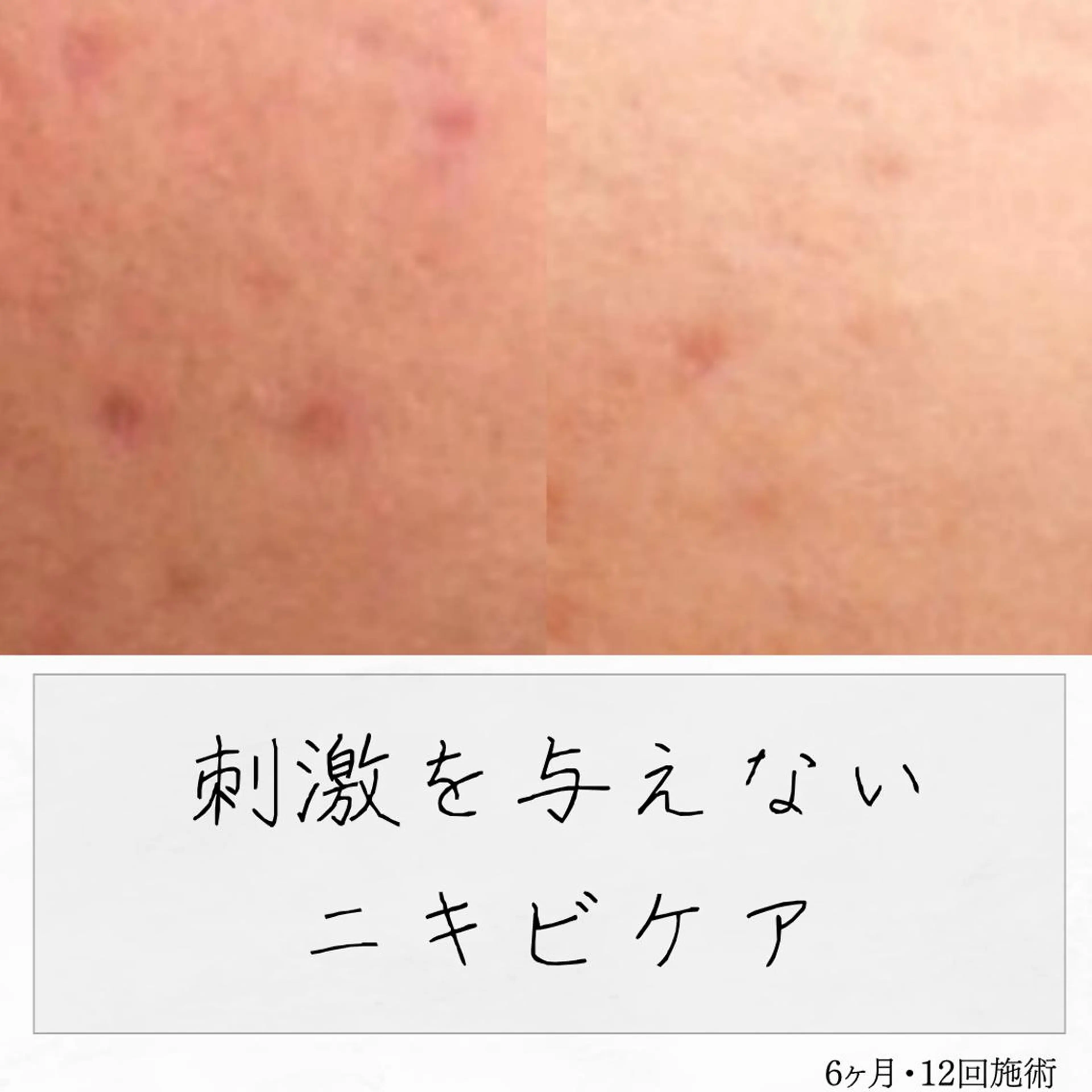 ニキビ経験者が施術 する専門サロン🌻のエステ・リラクイメージ