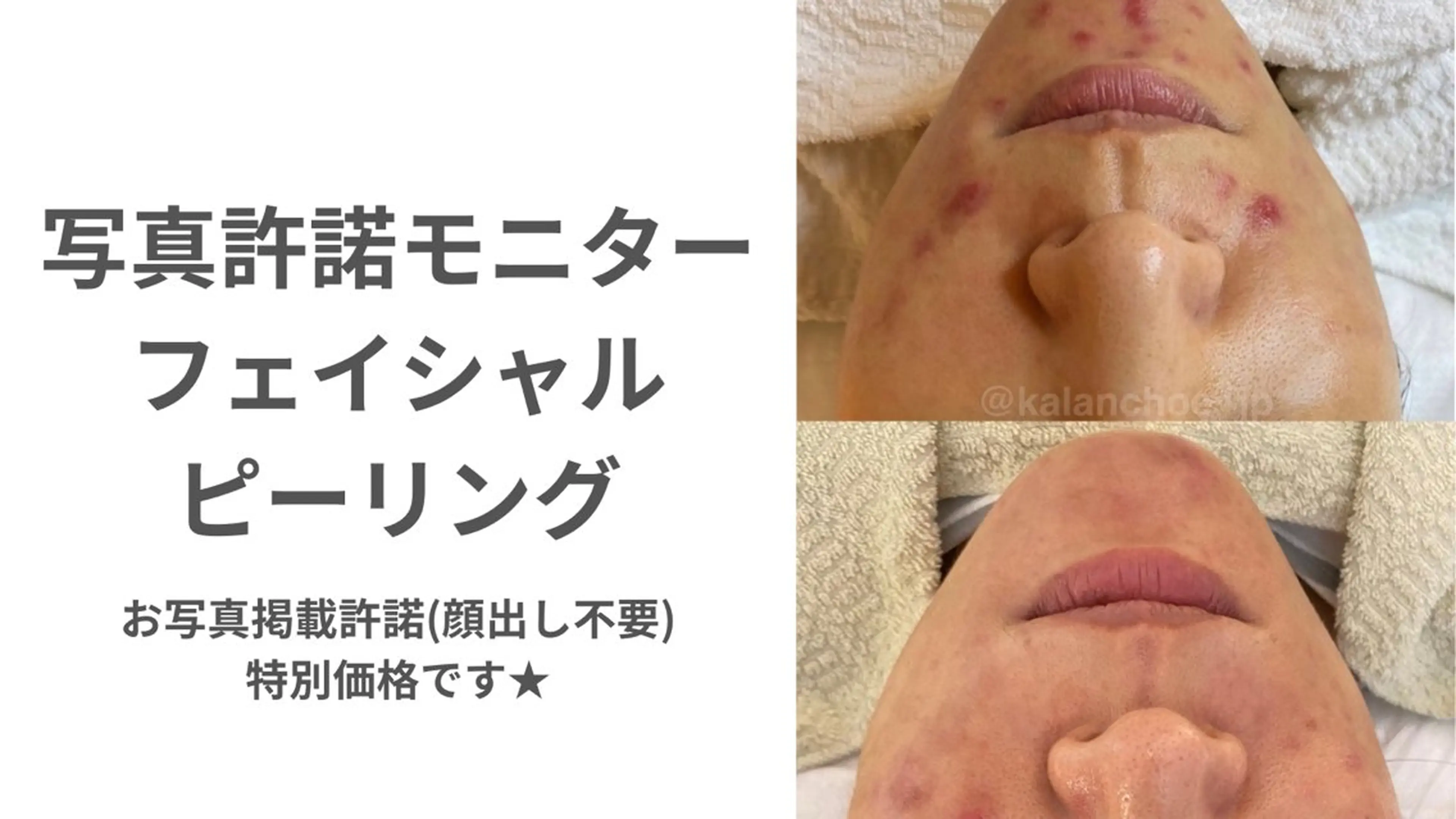 肌質改善 KALANCHOEのエステ・リラクイメージ