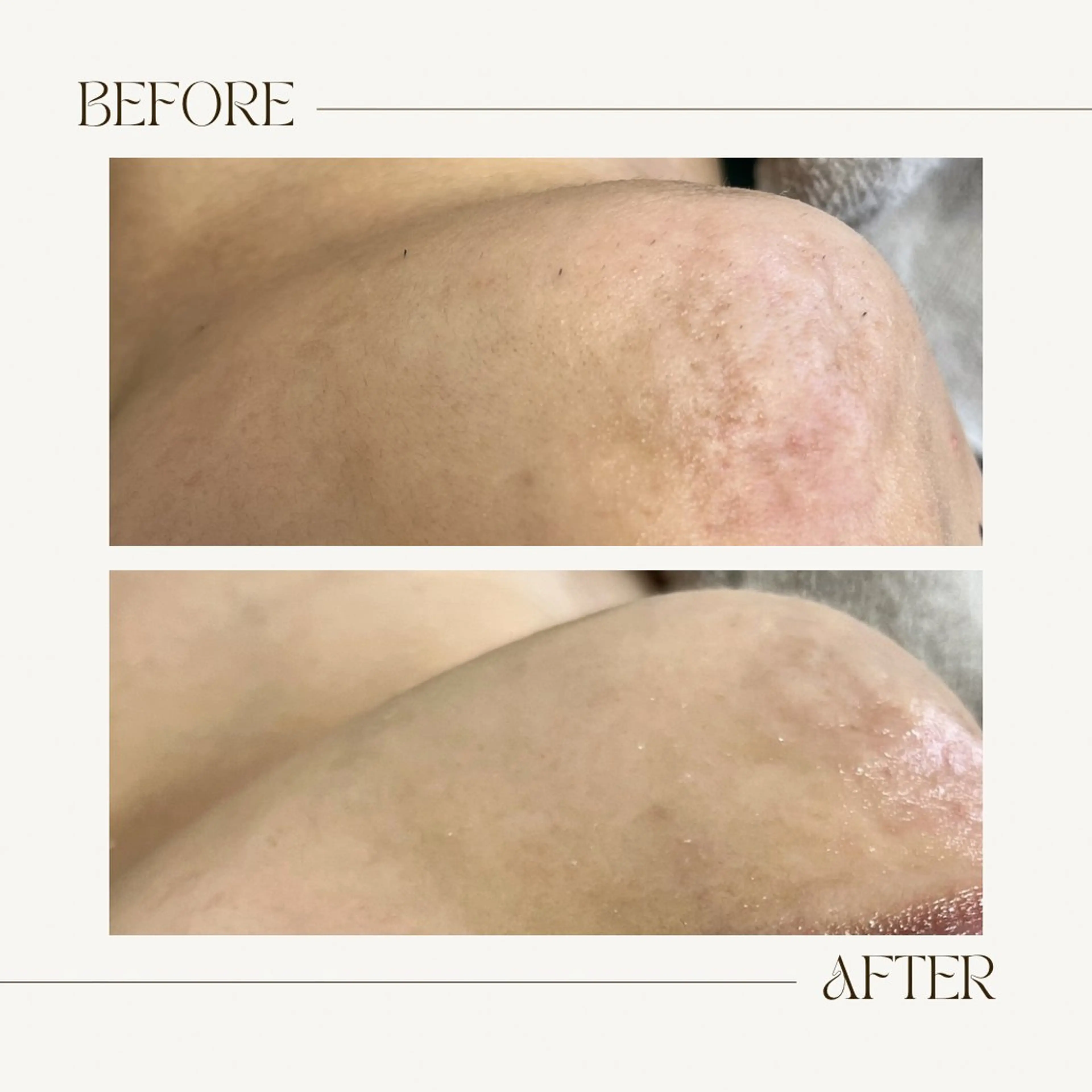 脱毛 1st｜フェイシャル エステ専門店のエステ・リラクイメージ