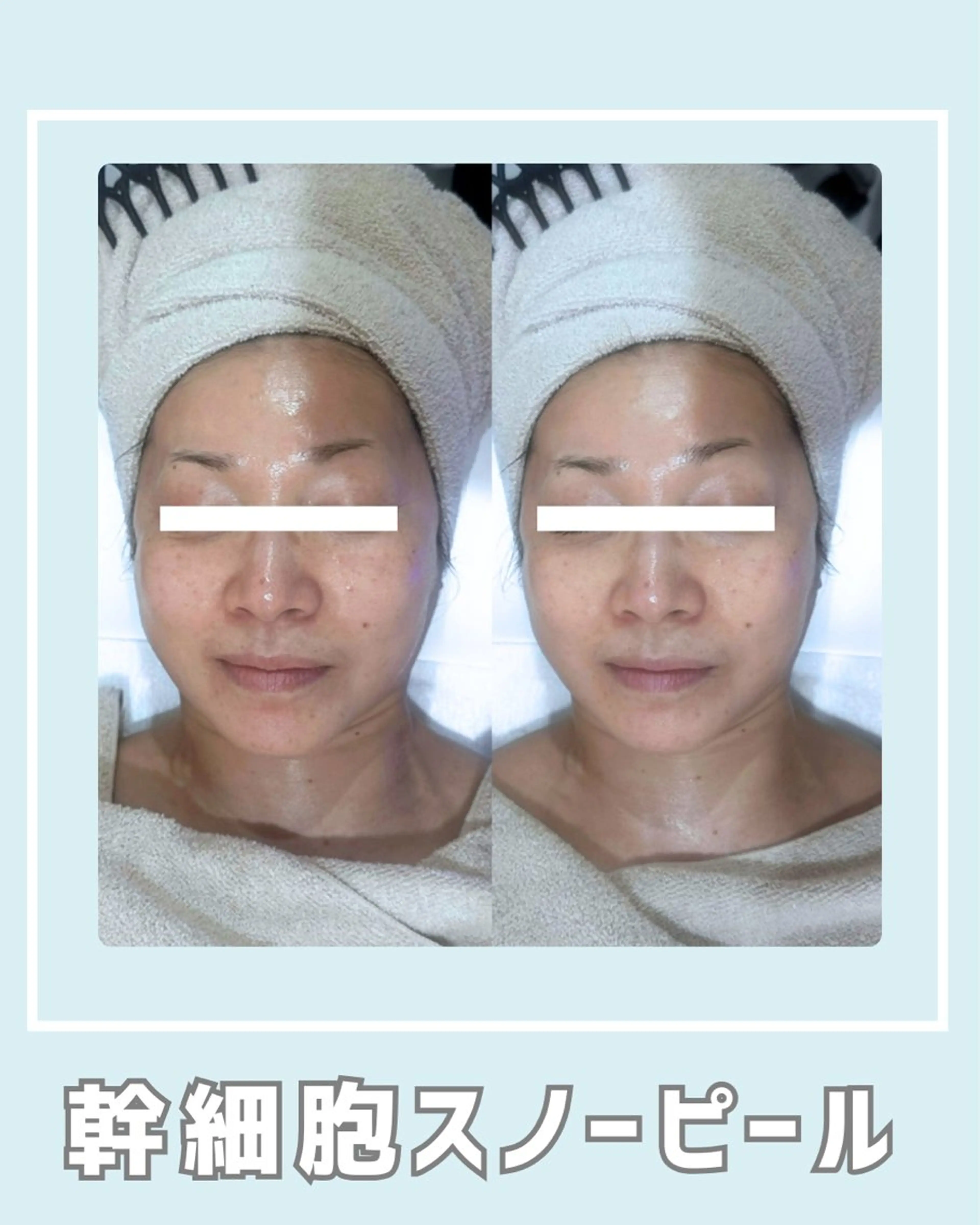 エステ |ピーリング・毛穴| soina神楽坂のエステ・リラクイメージ