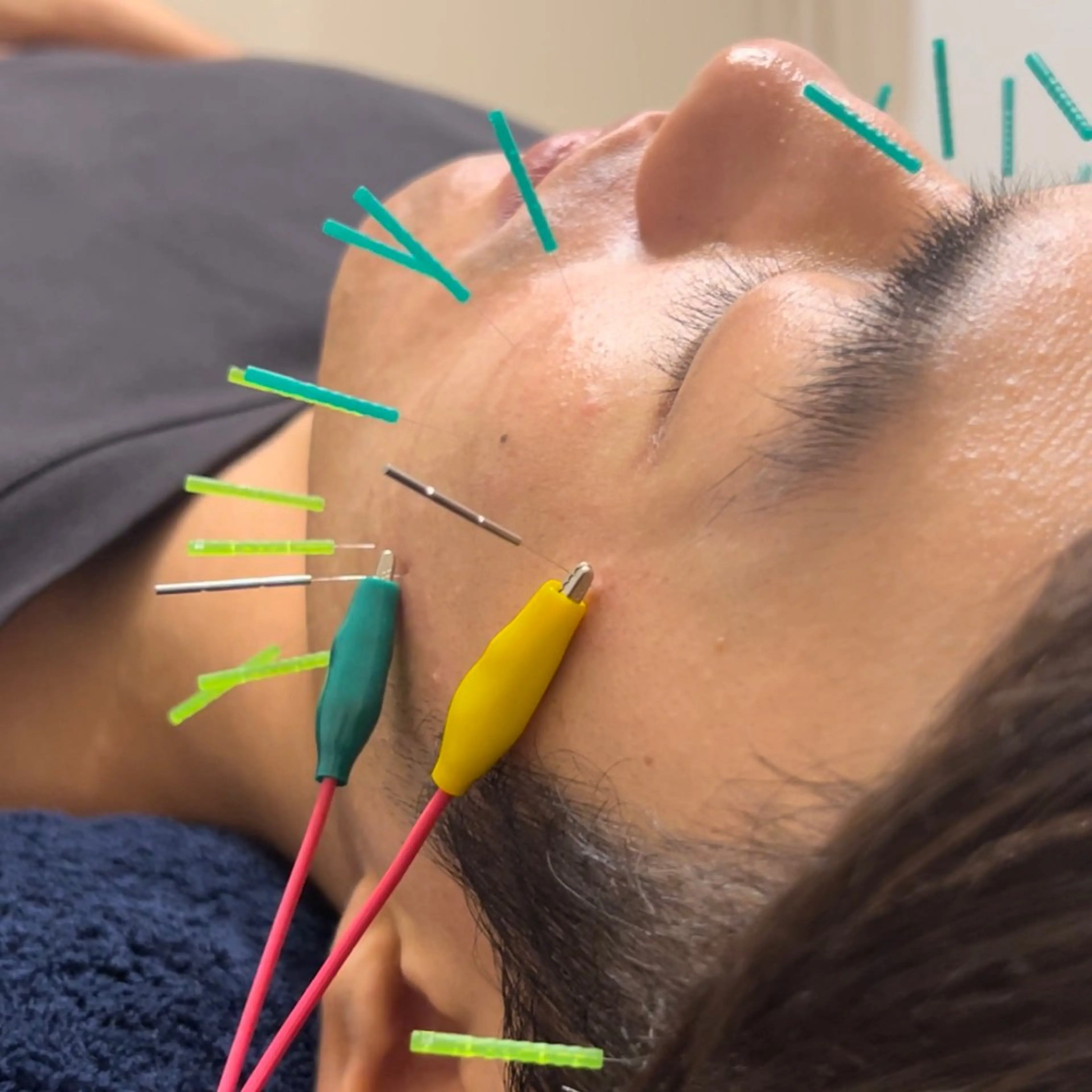 リラク 美容鍼×小顔×猫背× ブライダル 大阪梅田のエステ・リラクイメージ