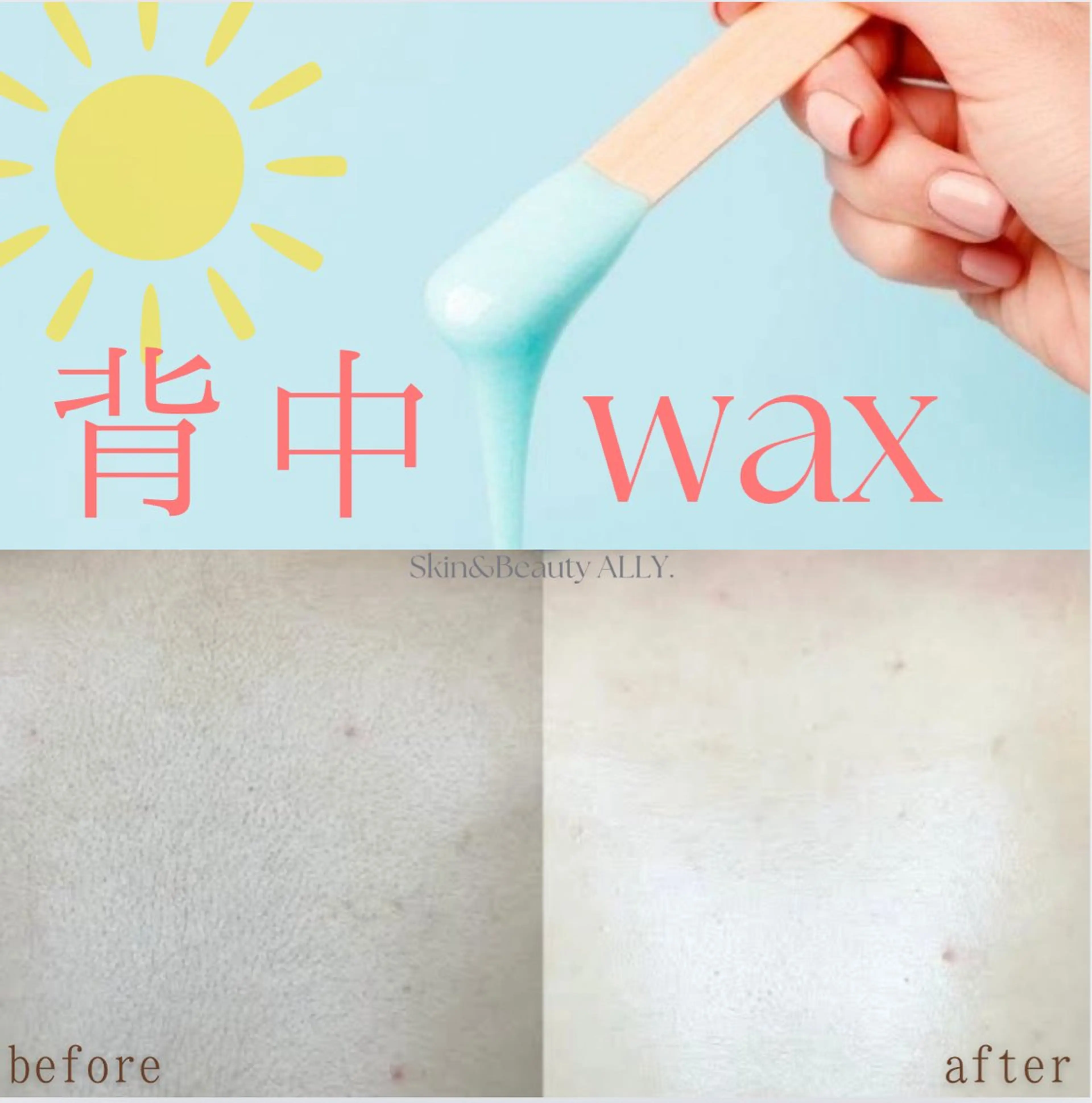 【WAX脱毛】背中上部WAX脱毛★保湿パック付♪の写真