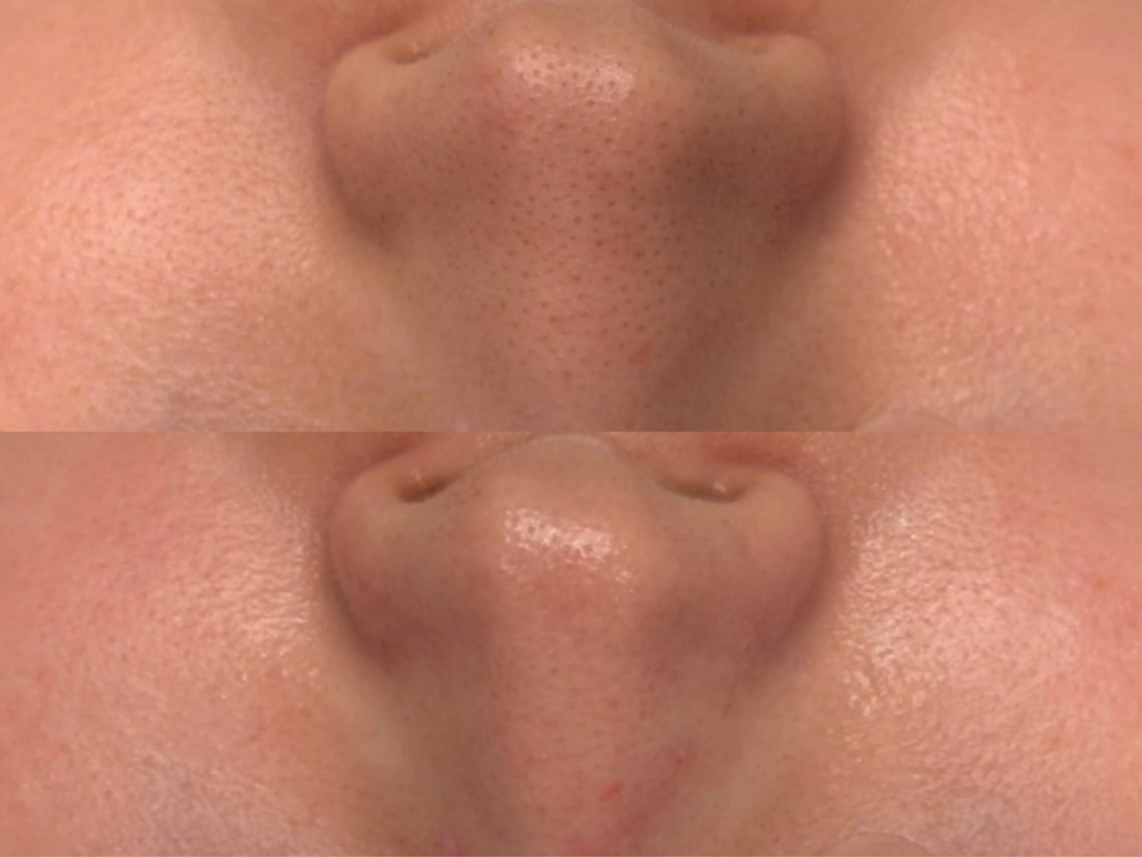 残り1名【毛穴×くすみ改善】韓国肌管理♪毛穴洗浄ハイドラ＆剥離なしハーブピーリング🌿¥28,000→¥11,500の写真