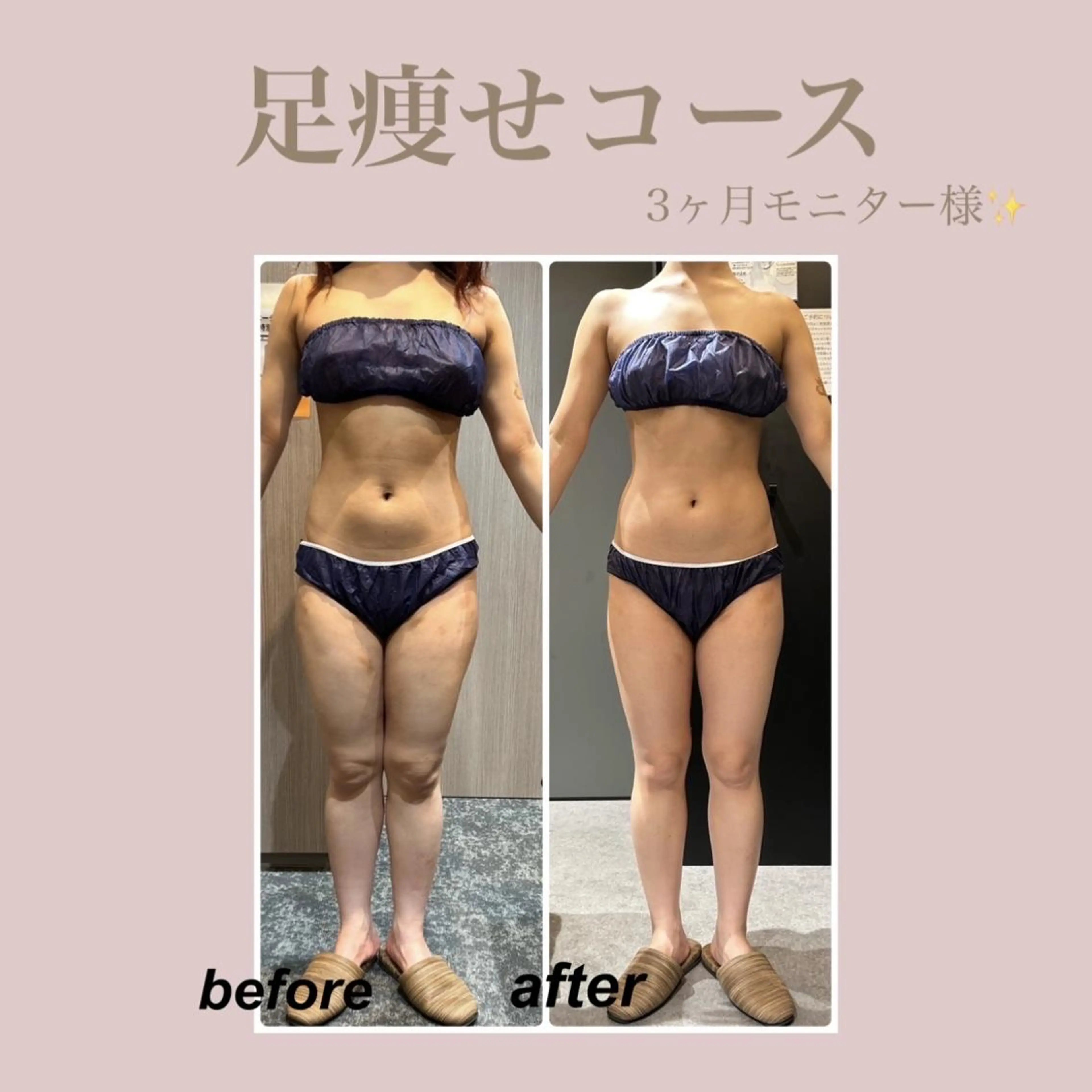 🤍4月限定🤍夏に向けたボディライン徹底プラン🌟エステでしかできないセルライトケアで最強美脚を手に入れよう✨の写真