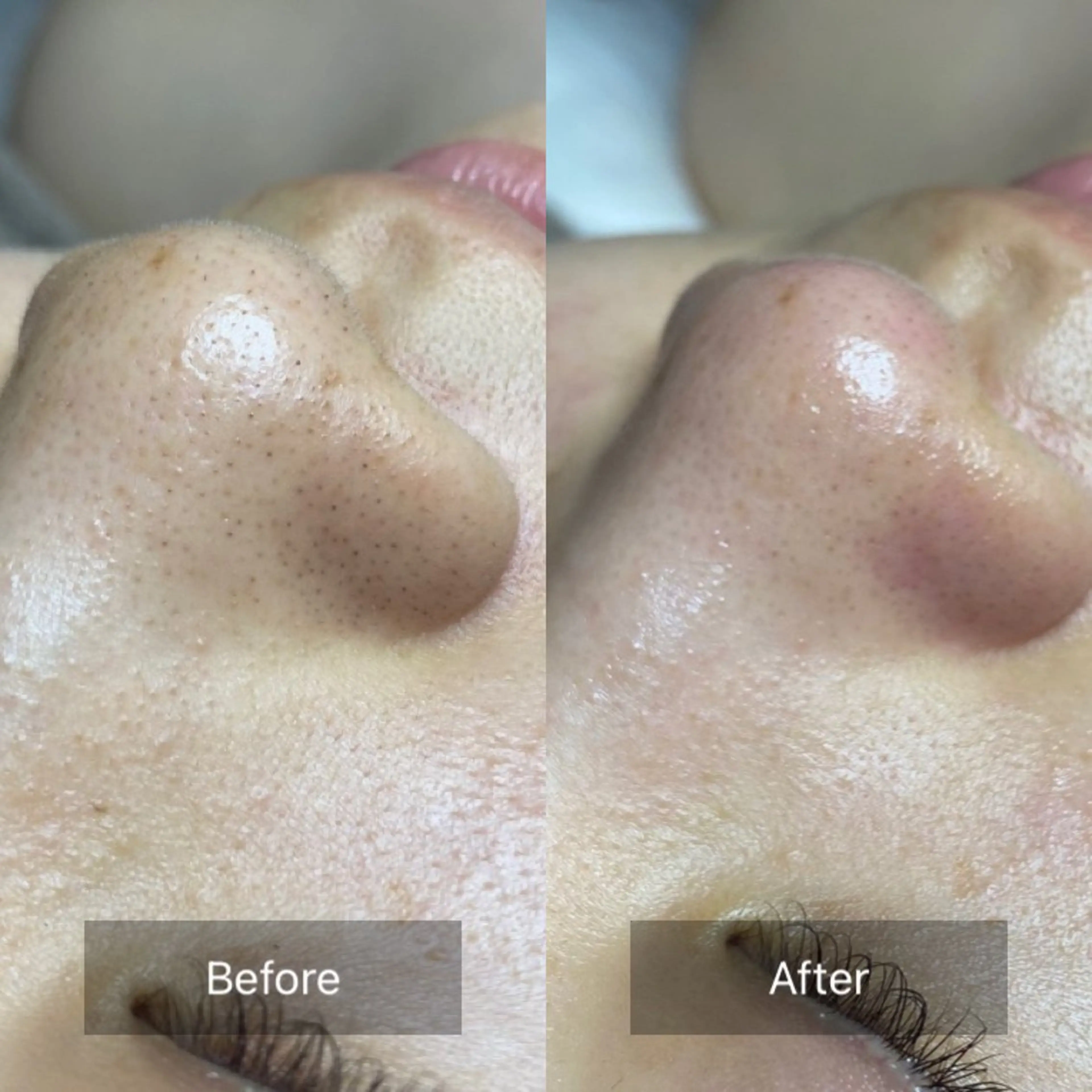 50%OFF‼️毛穴洗浄❣️いちご鼻改善【パック＆デコルテリンパ＆ヘッドスパ付】カウンセリング込90分の写真